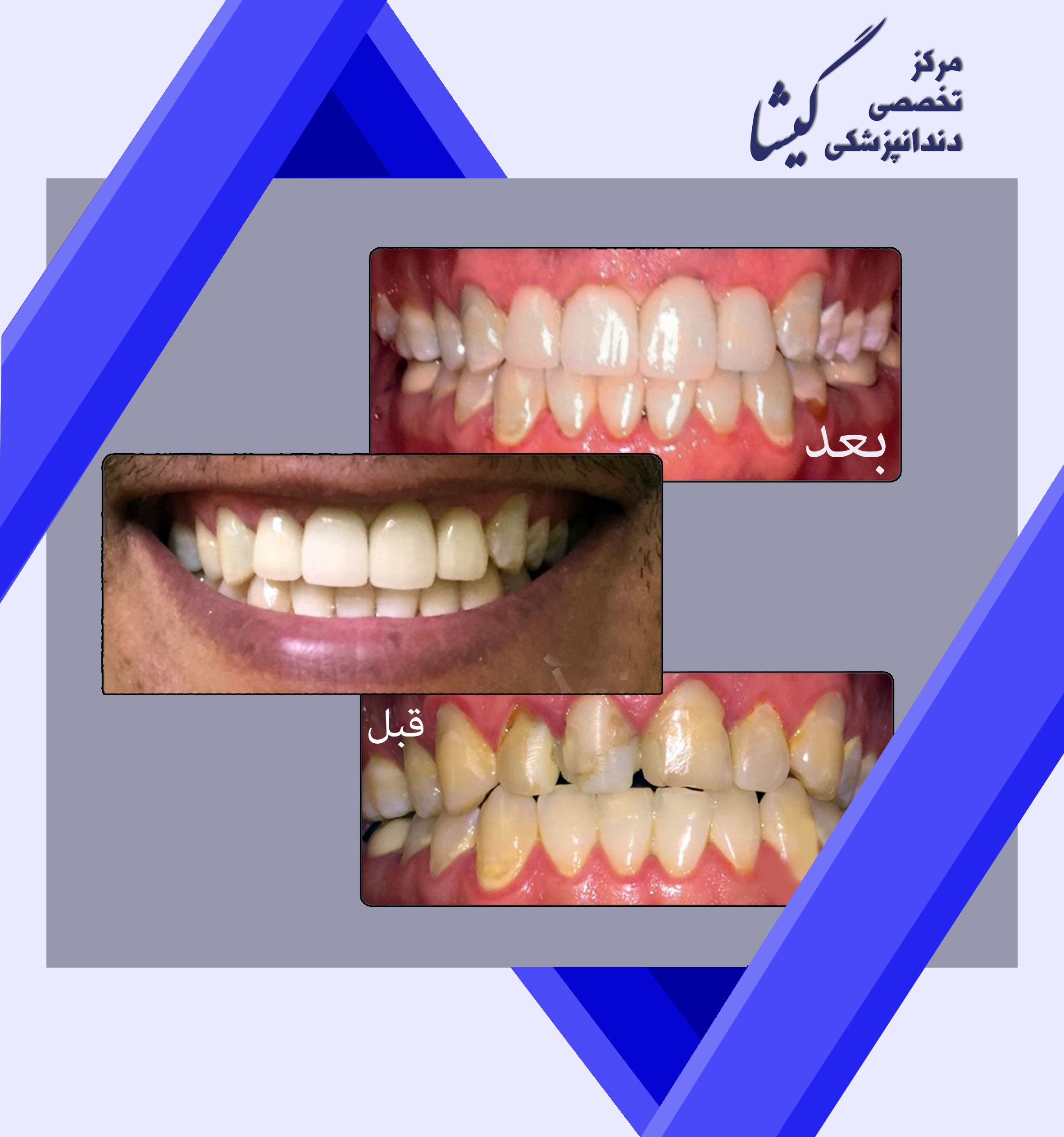 سه واحد روكش تماس سراميك و يك واحد لامينيت سراميكي براي چهار دندان جلويي