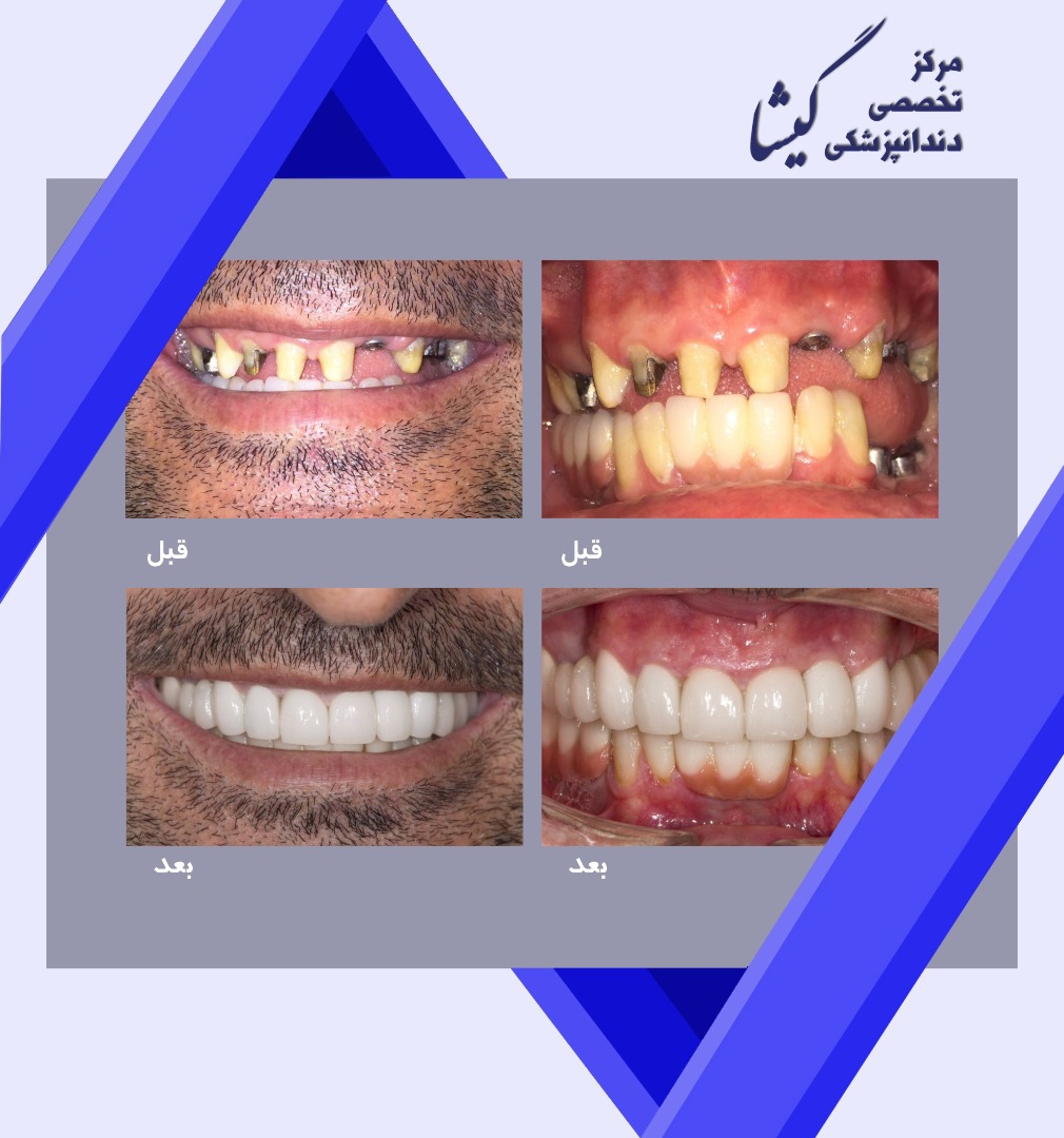 بازسازی کل دندانهای بالا و پایین با ترکیبی از ایمپلنت و روکش تمام سرامیک و کامپوزیت توسط متخصص ایمپلنت و پروتزهای دندانی در تهران