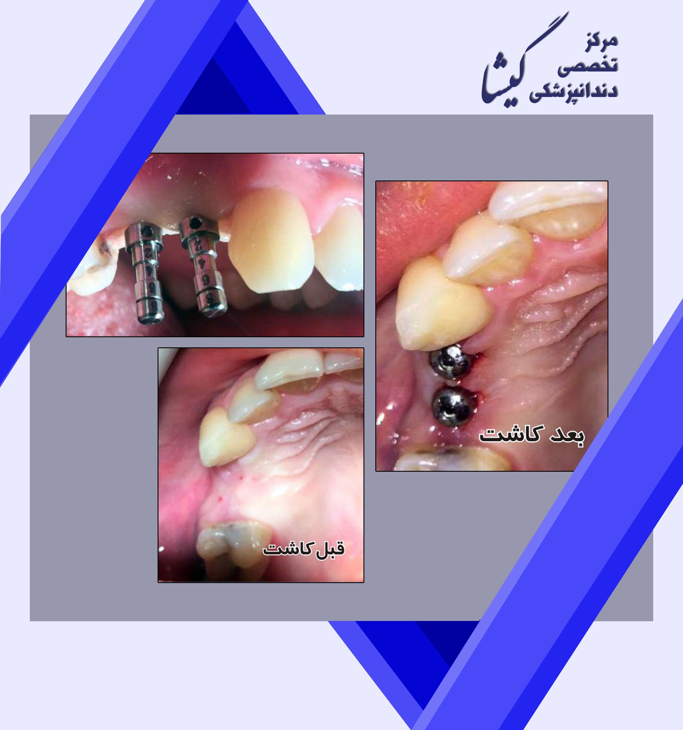 ایمپلنت بدون نیاز به برش لثه