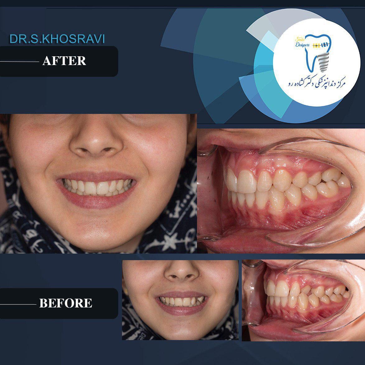 ارتودنسی تک فک بالا