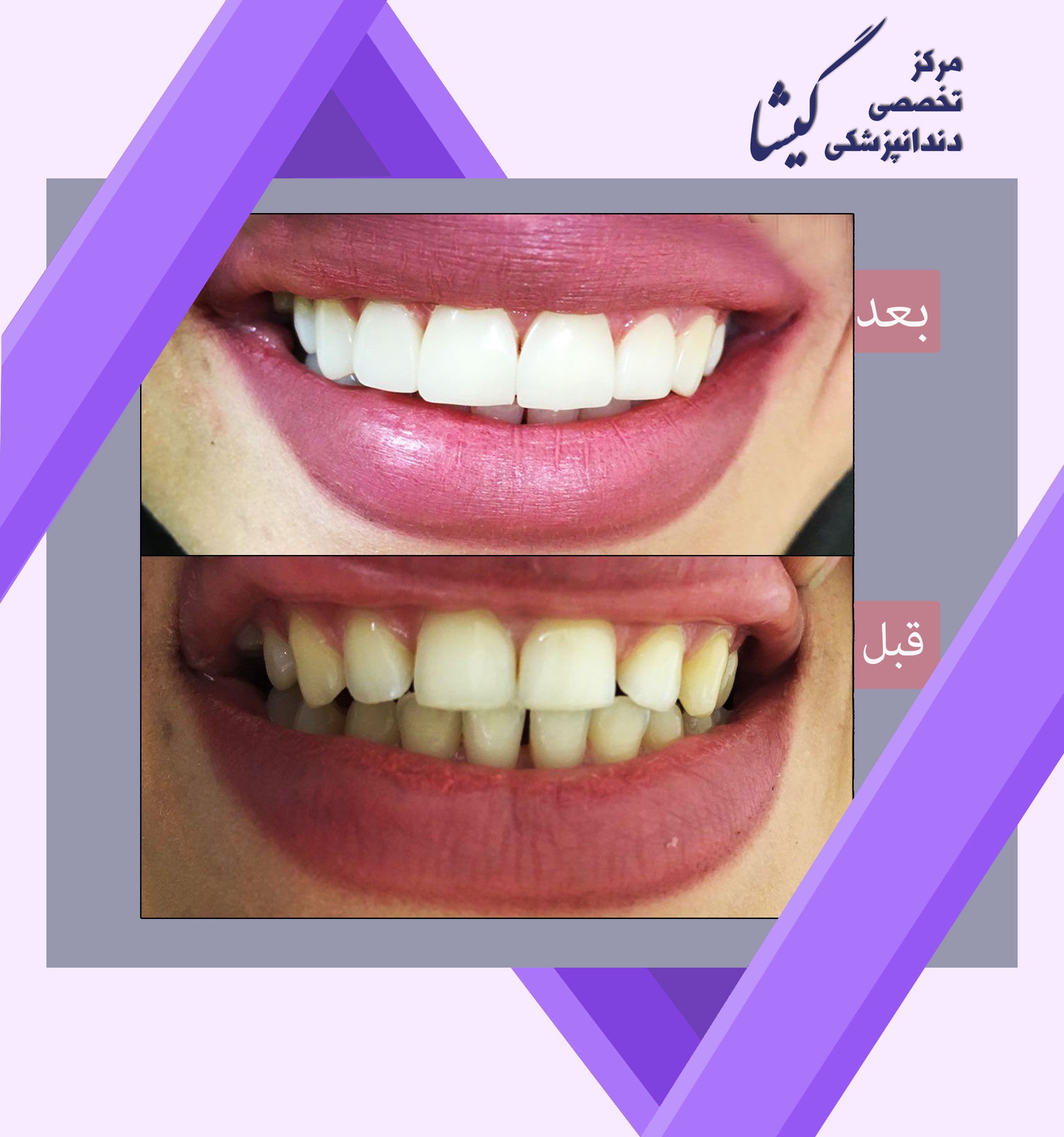 ونير كامپوزيت