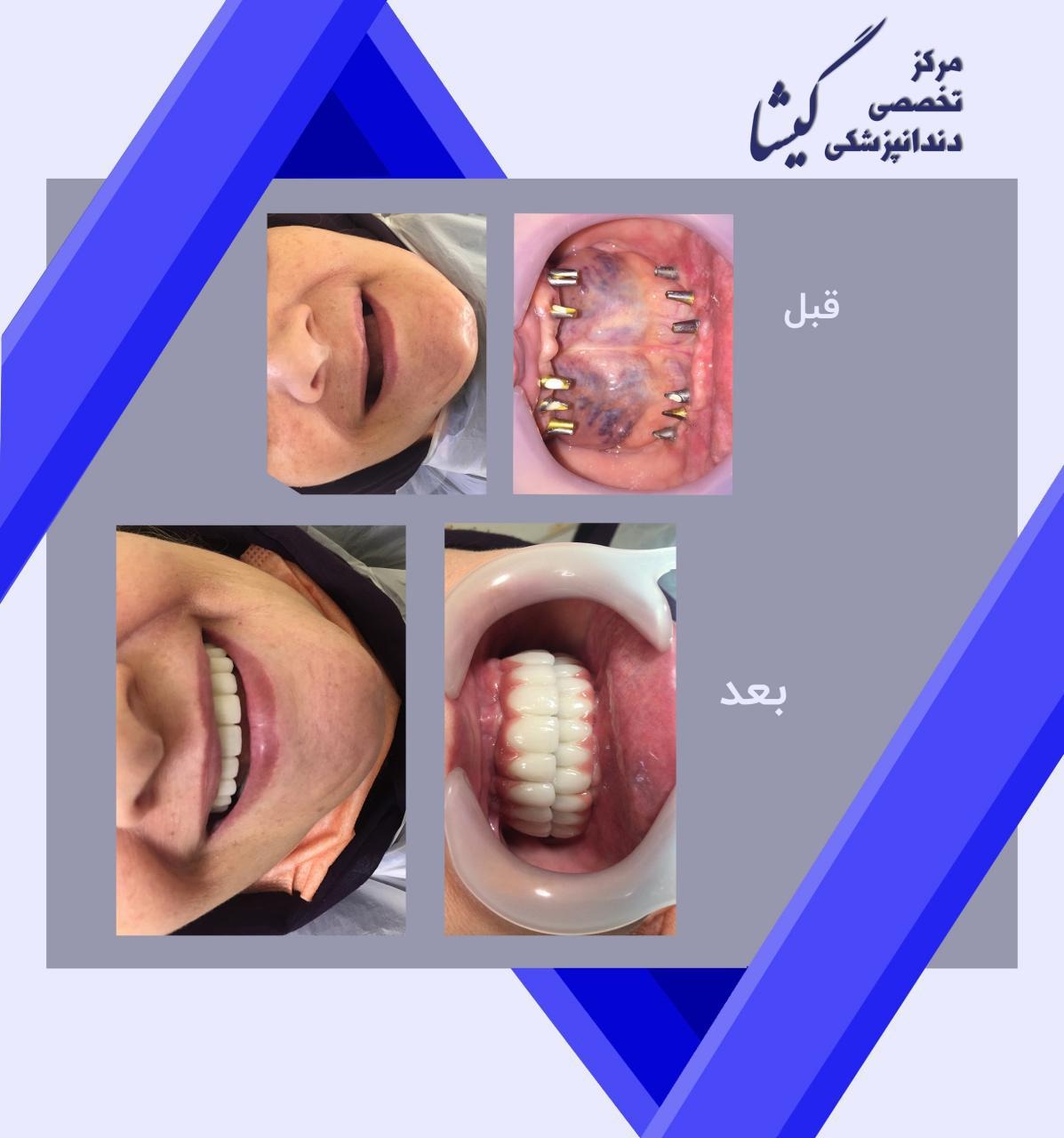بازسازی کامل هردو فک بی دندان با ایمپلنت