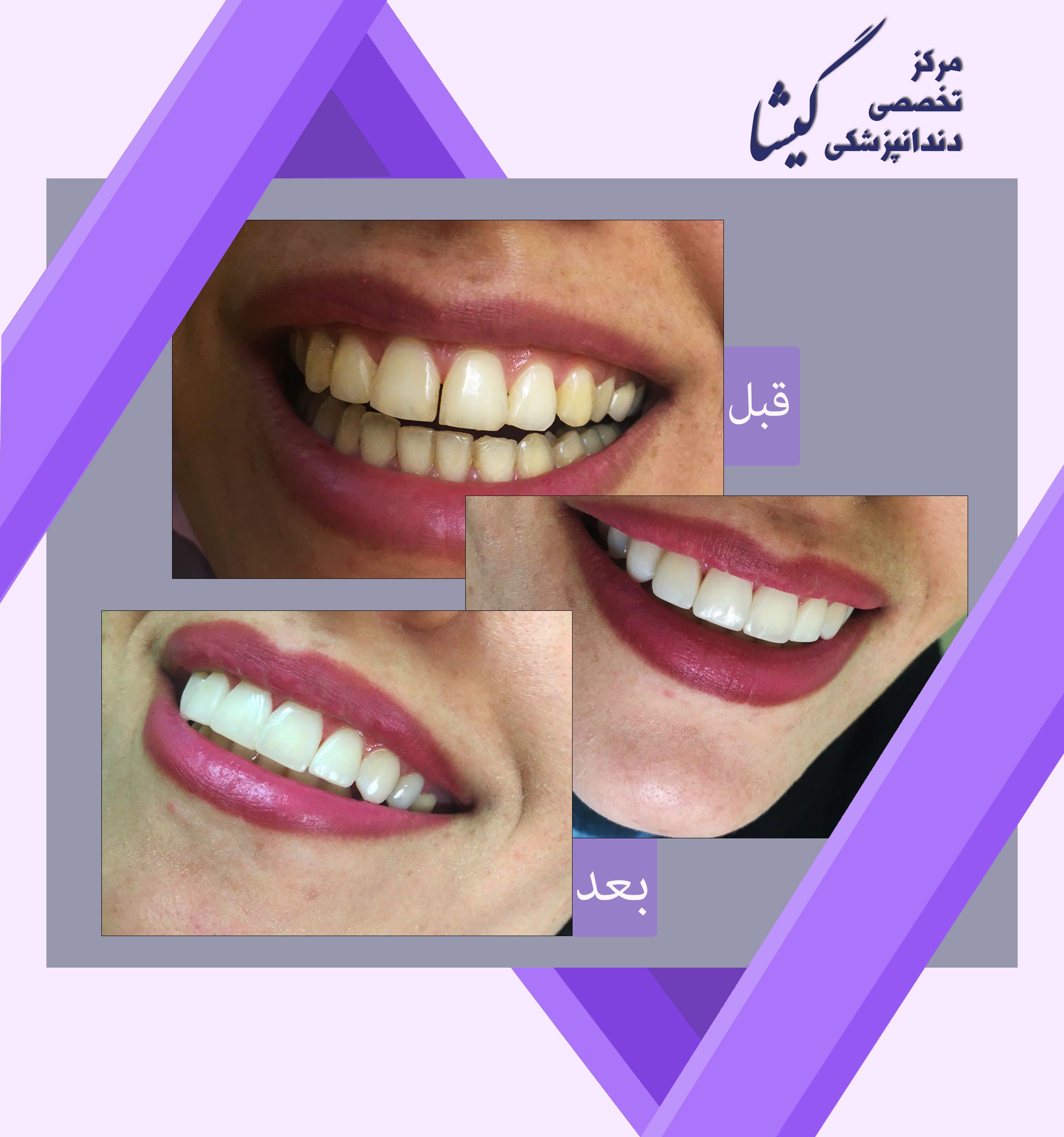 كامپوزيت ونير و اصلاح رنگ و فرم دنداني و بستن فضاهاي بين دنداني
