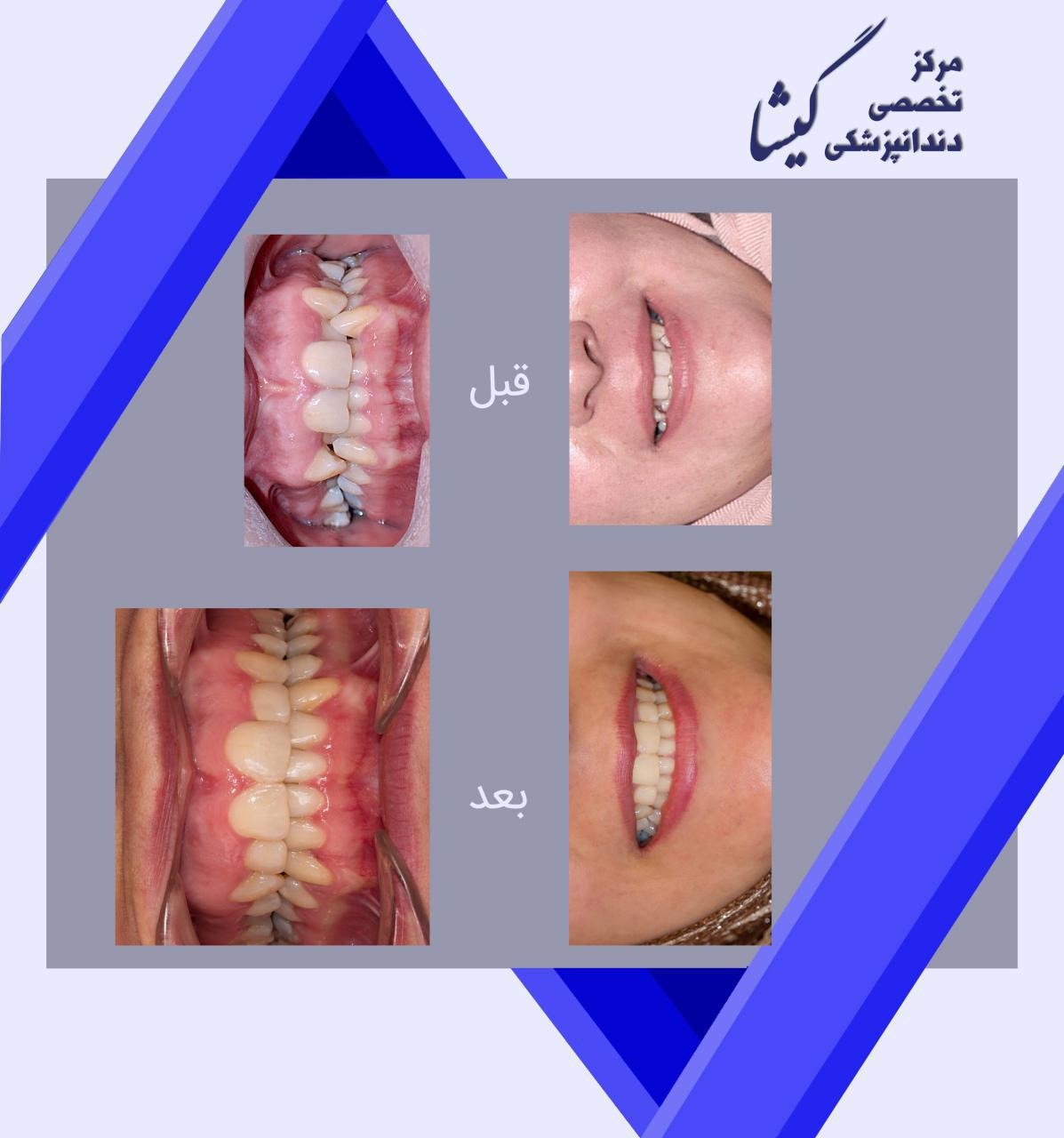 ارتودنسي بدون كشيدن دندان براي دندانهاي بسيار نامرتب