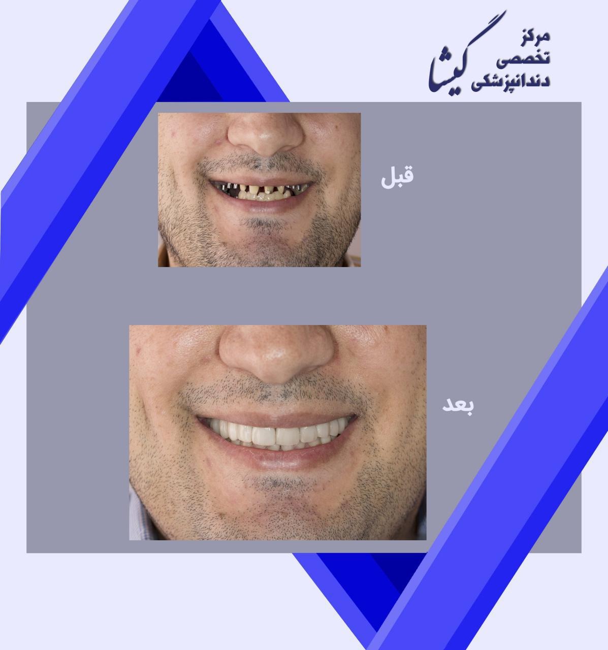 بازسازی دندانهای بیمار عزیزمان با ایمپلنت دندان و روکش