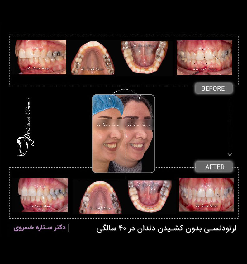 نامرتبي شديد دندانها