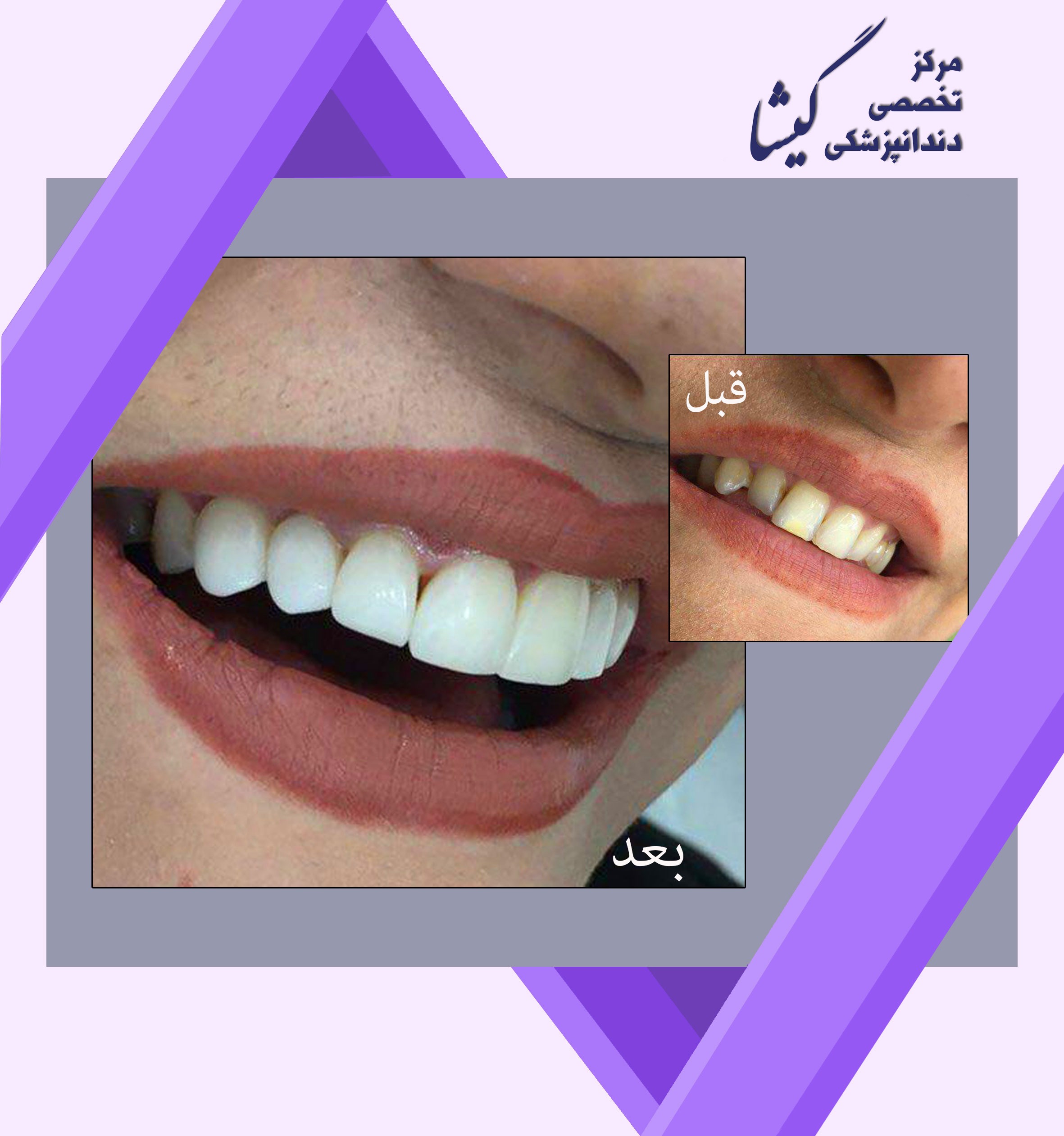 ونير كامپوزيت