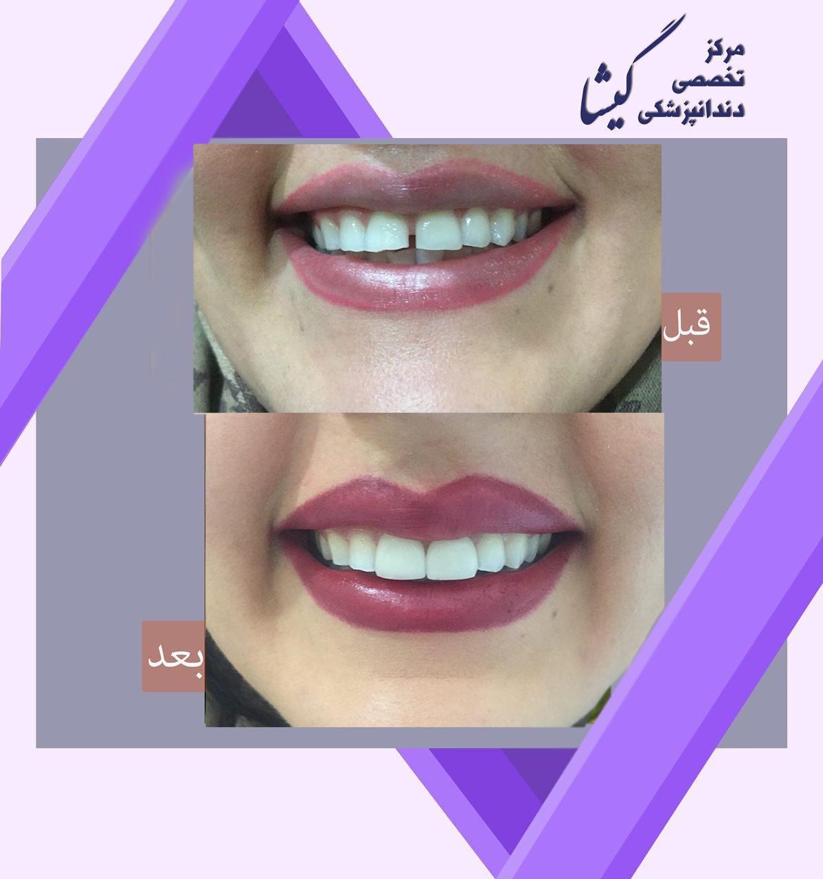 لامینیت سرامیکی دو دندان جلو برای بستن فاصله بین دو دندان.