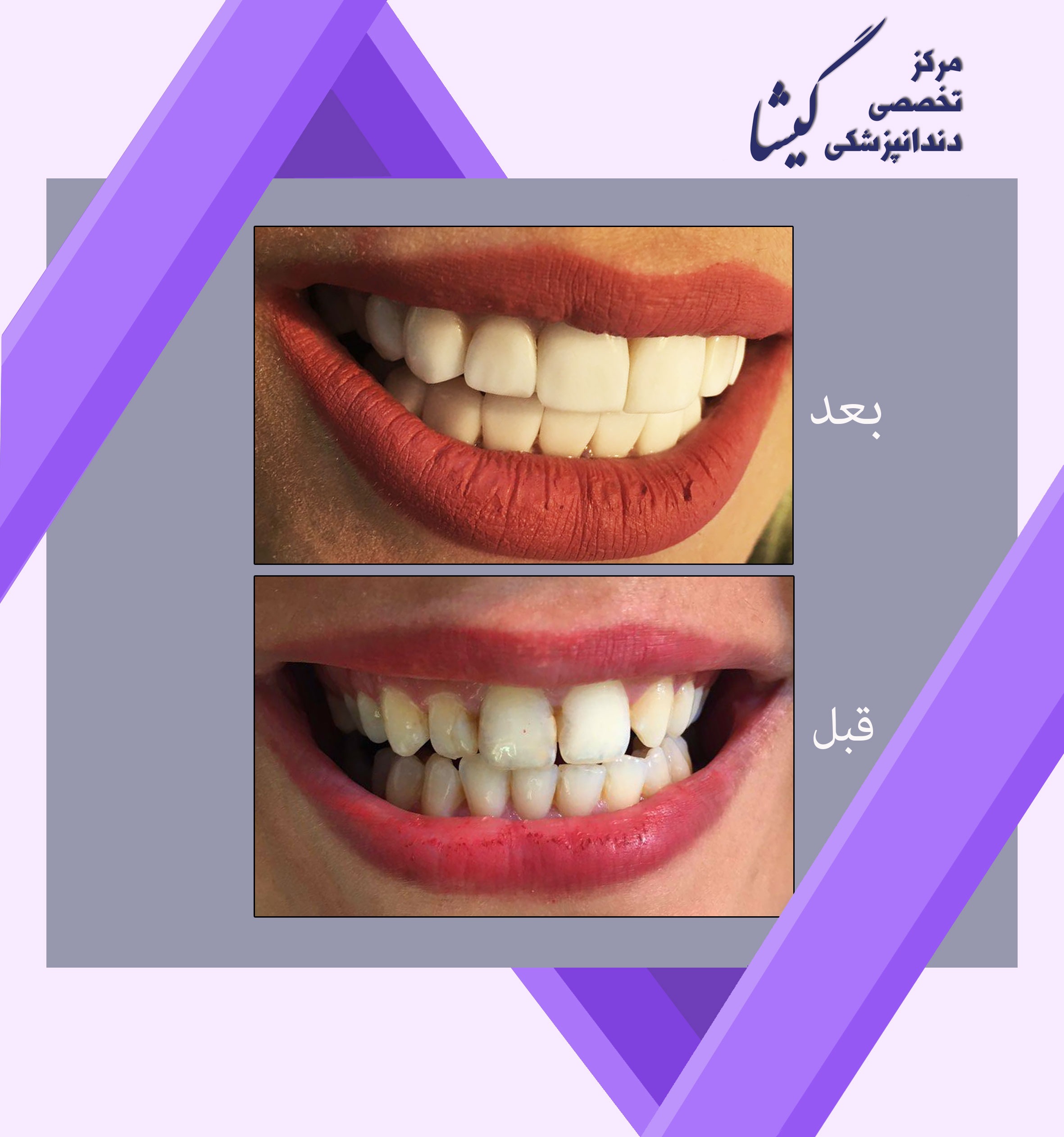 ونير كامپوزيت