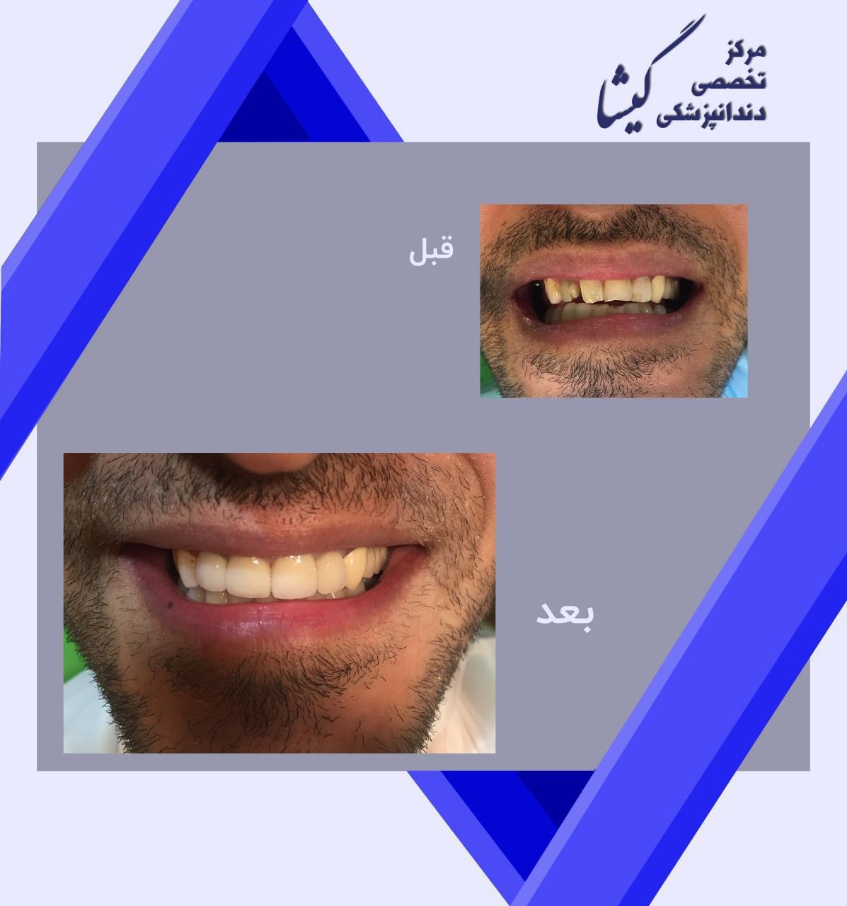 واحد روکش زیرکونیا