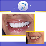 روکش تمام سرامیک دندانهای بالا  توسط متخصص پروتزهای دندانی و ایمپلنت( دکتر عزیز گشاده رو ، هیئت علمی دانشگاه شهید بهشتی ، رتبه اول بورد کشور)