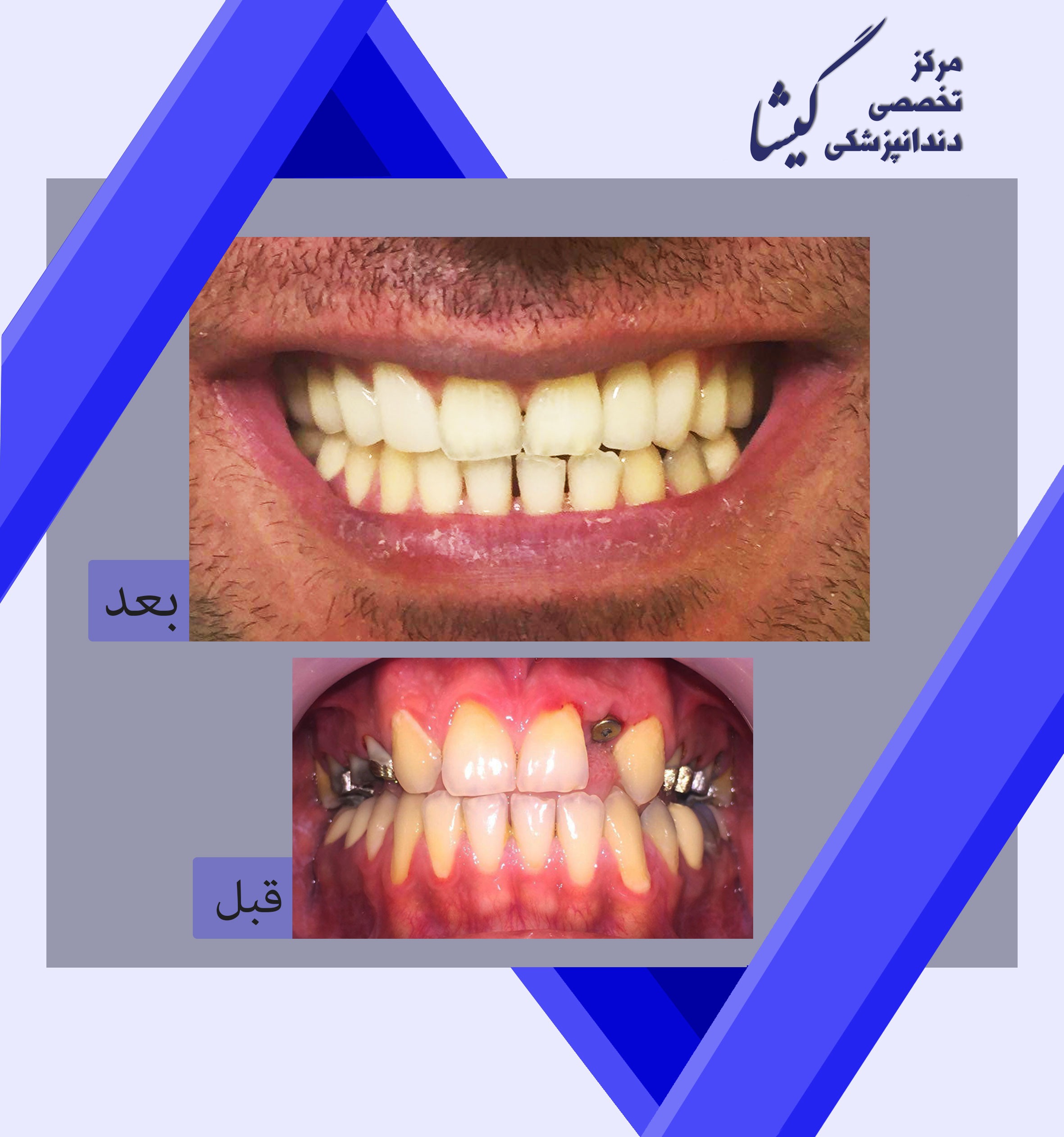 ايمپلنت و روكش هاي تمام سراميک و كامپوزيت ونير