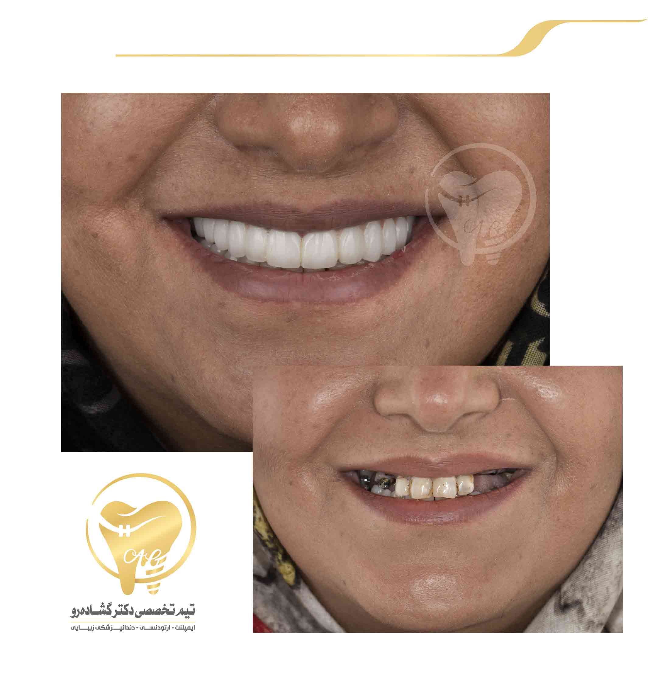 نمونه درمان ایمپلنت دندان