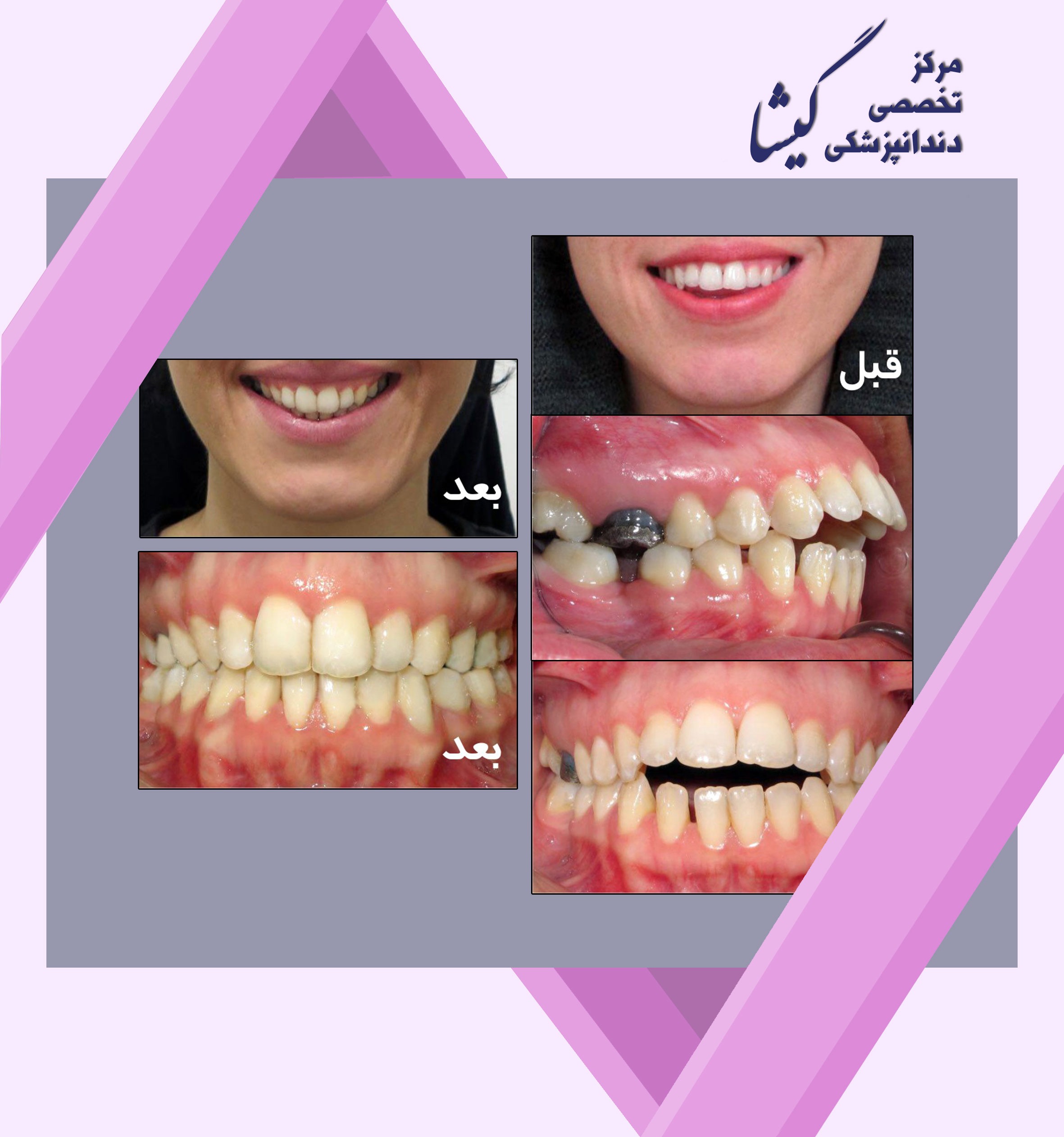 فاصله بين دندانهاي بالا و پايين