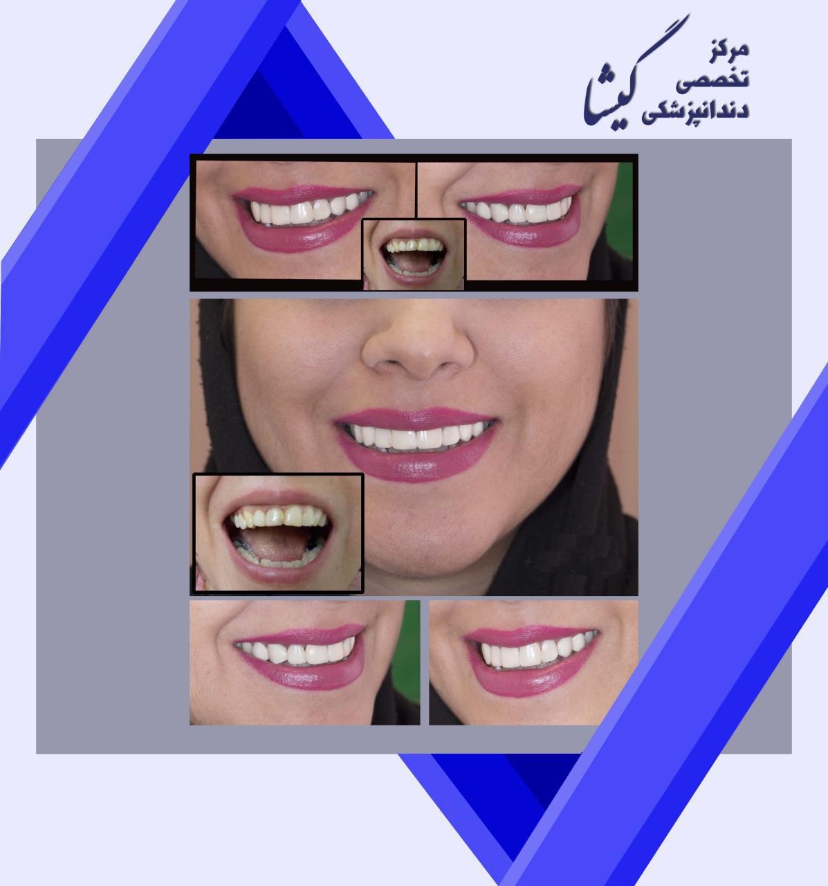 کامپوزیت ونیر