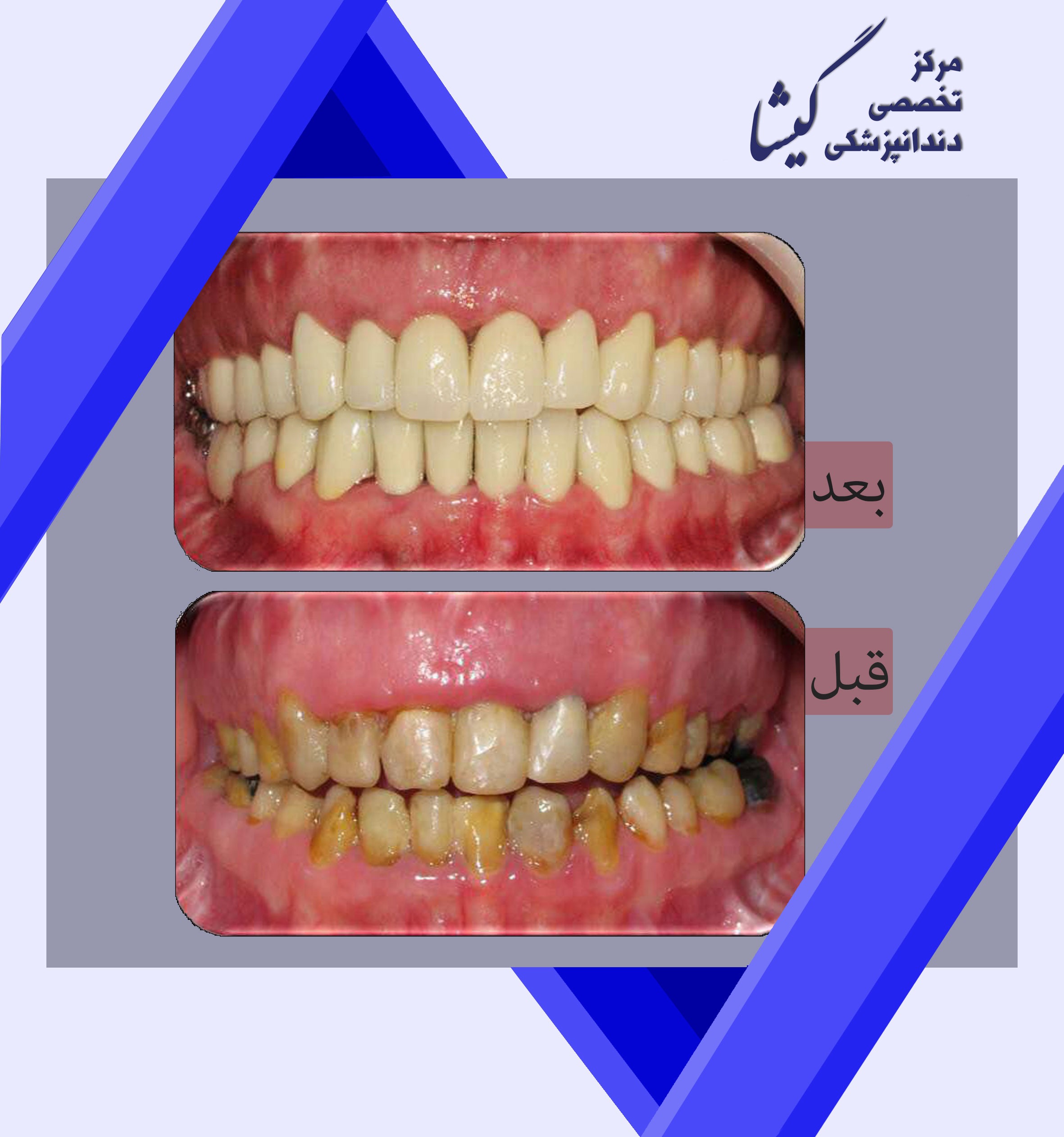 روکش کل دندانهای فک بالا و پایین هم برای افزایش استحکام و هم برای زیبایی