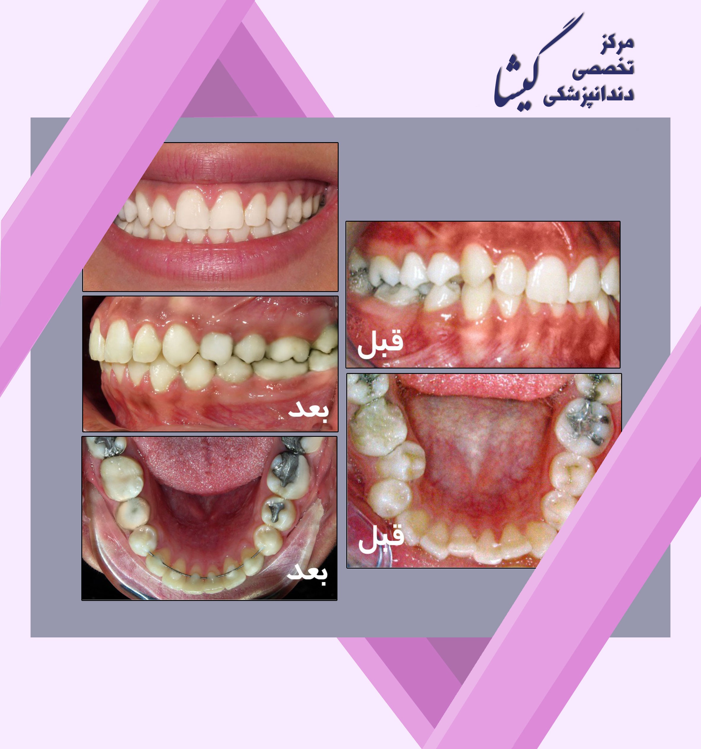دندان آسياي كوچك دوم در سمت راست فك پايين