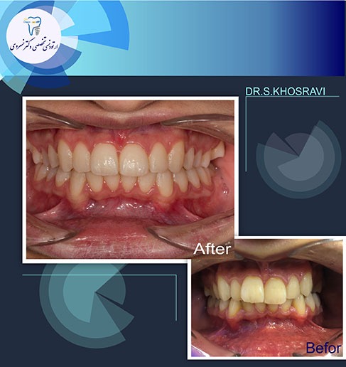 پهن کردن (گسترش عرض فک بالا و پایین) با ارتودنسی