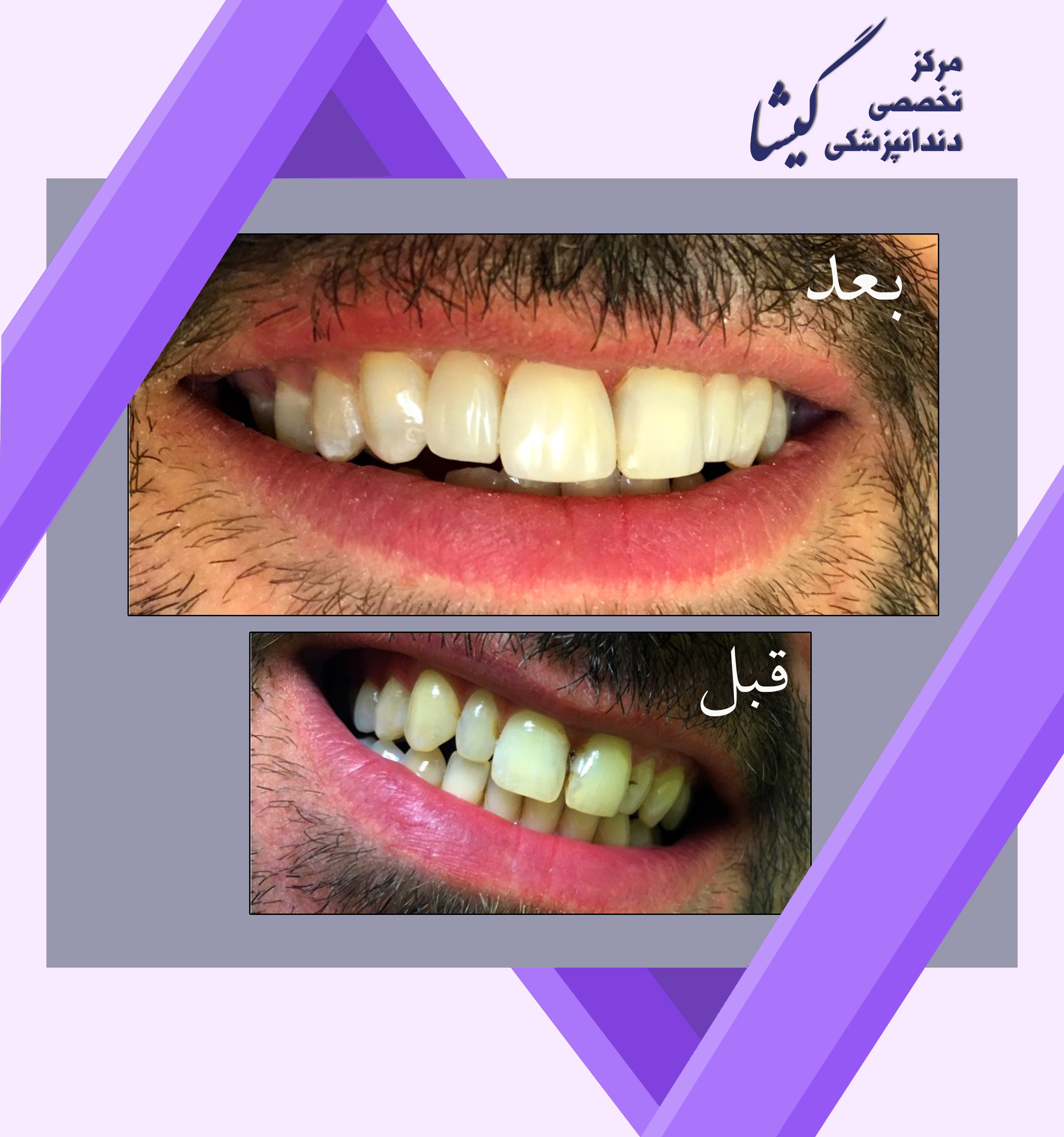 طراحي لبخند زيبا و طبيعي