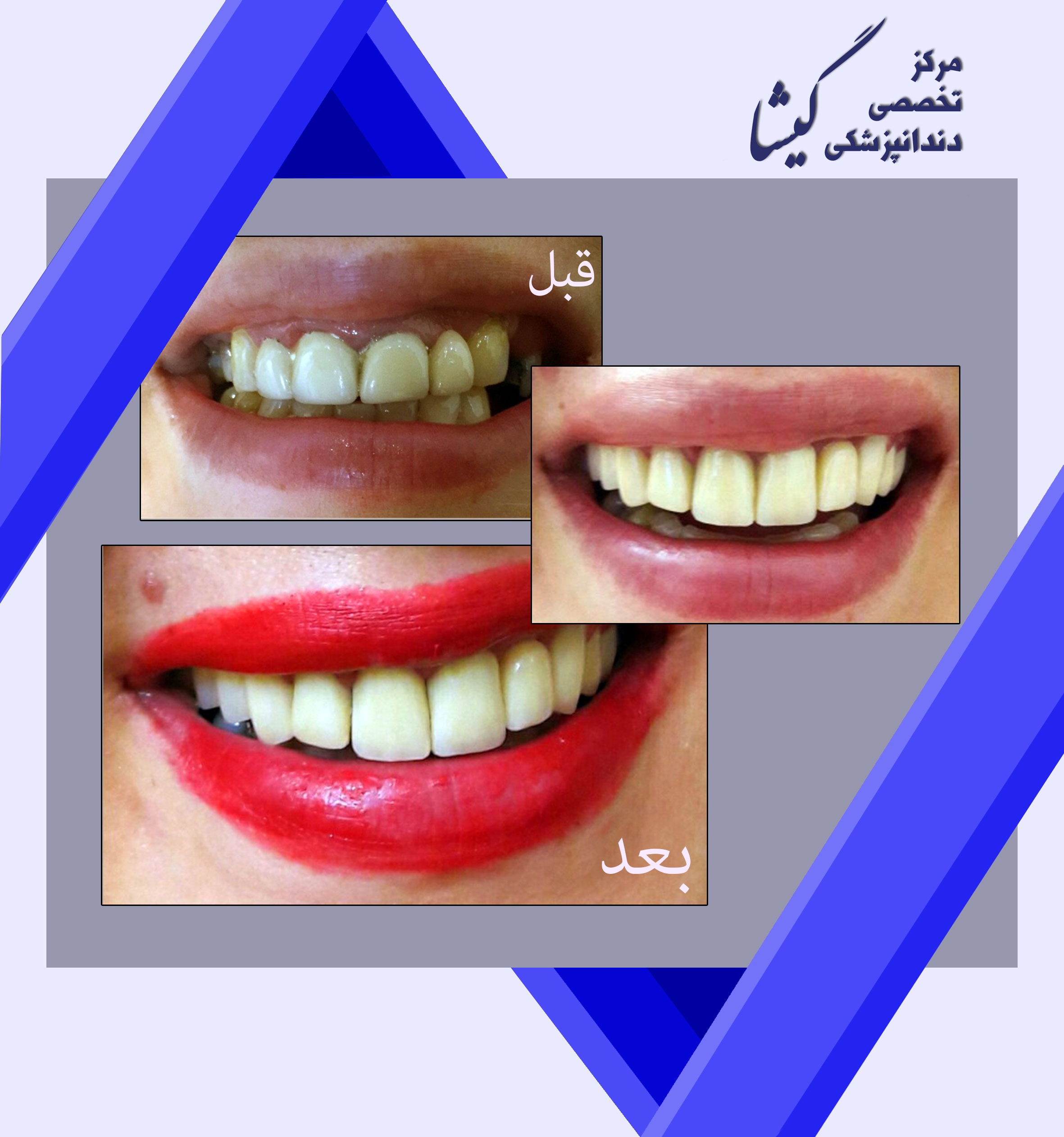 حل مشکلاتی مثل تورم و قرمزی لثه، ارتفاع کوتاه روکش های قدیمی، ته رنگ فلزی روکش ها