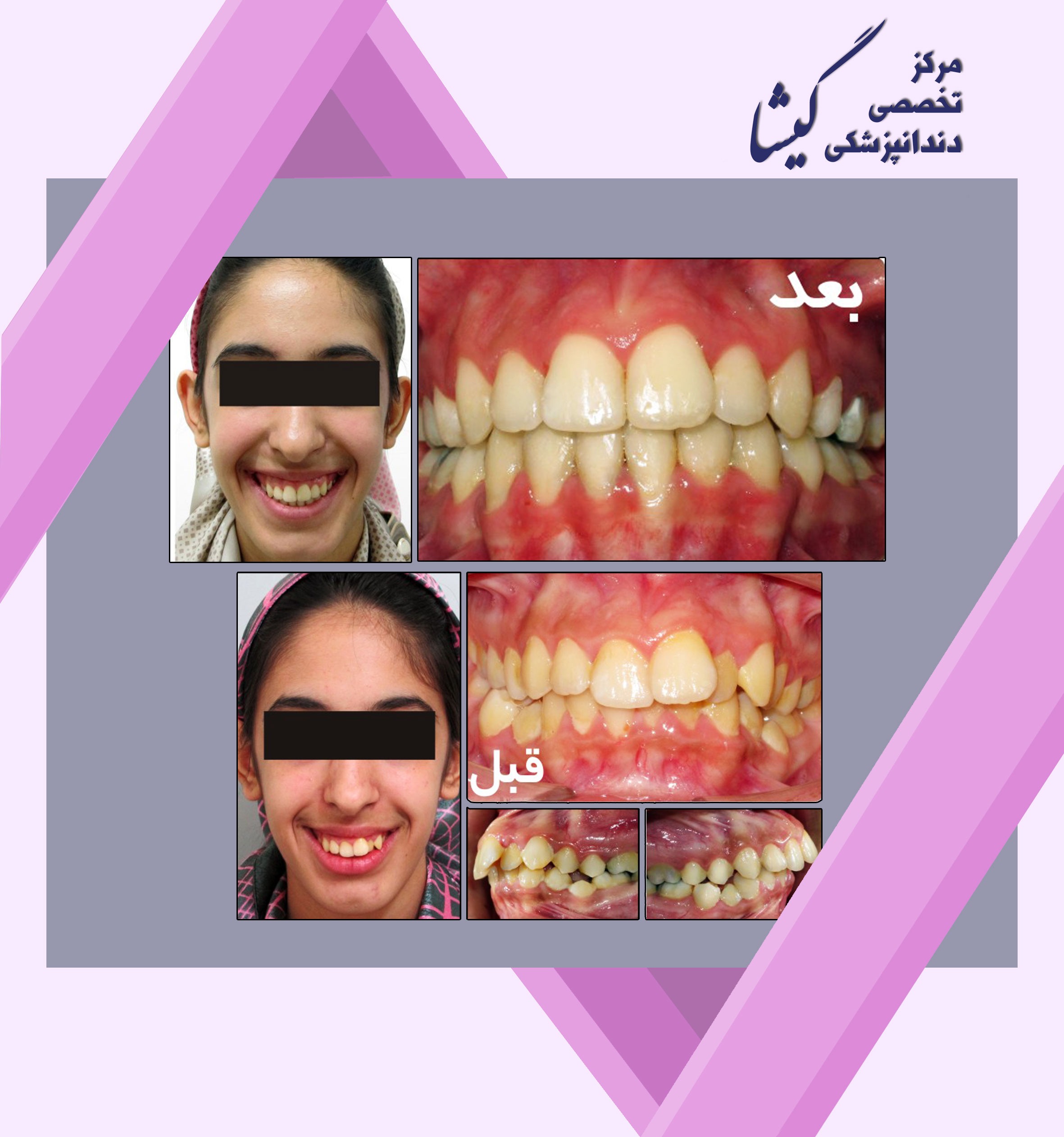 بيرون زدگي دندانهاي فك بالا و كمبود فضاي شديد براي دندانهاي فك پايين