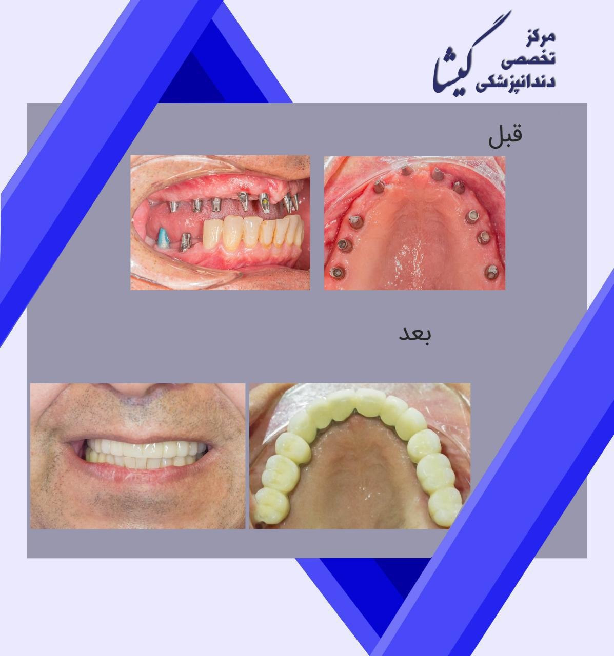 بازسازی دندانهای فک بالا و پایین با ایمپلنت توسط متخصص ایمپلنت