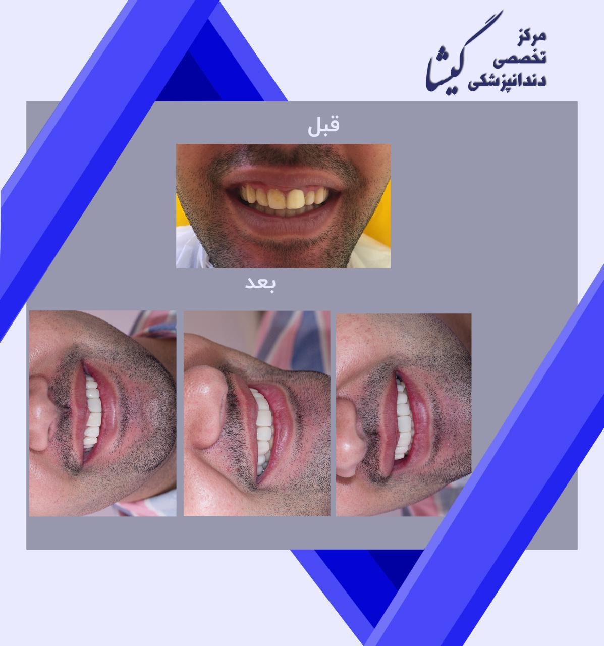 طراحی لبخند  با ۸ واحد لامینیت سرامیکی و روکش