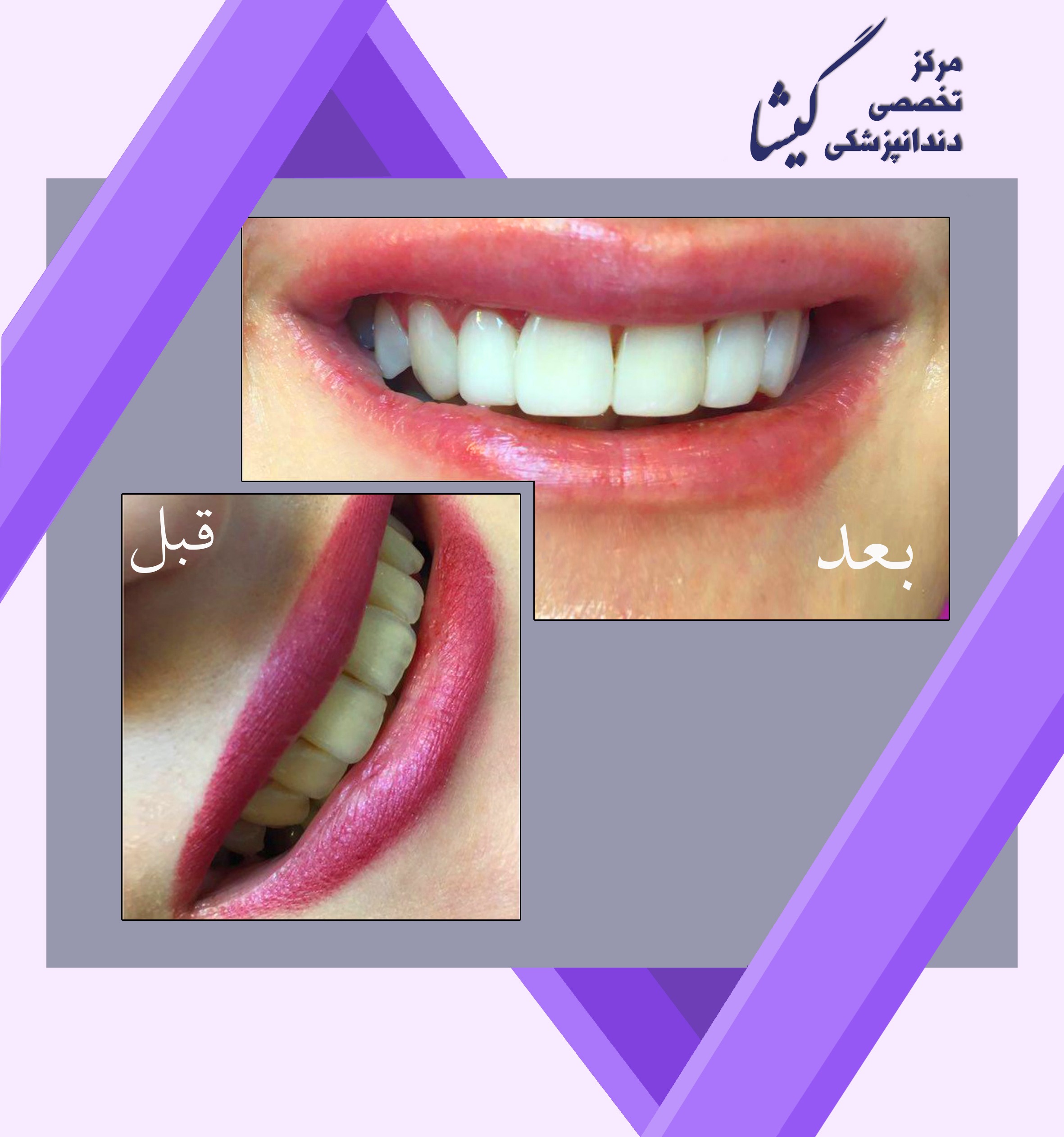 ونير كامپوزيت