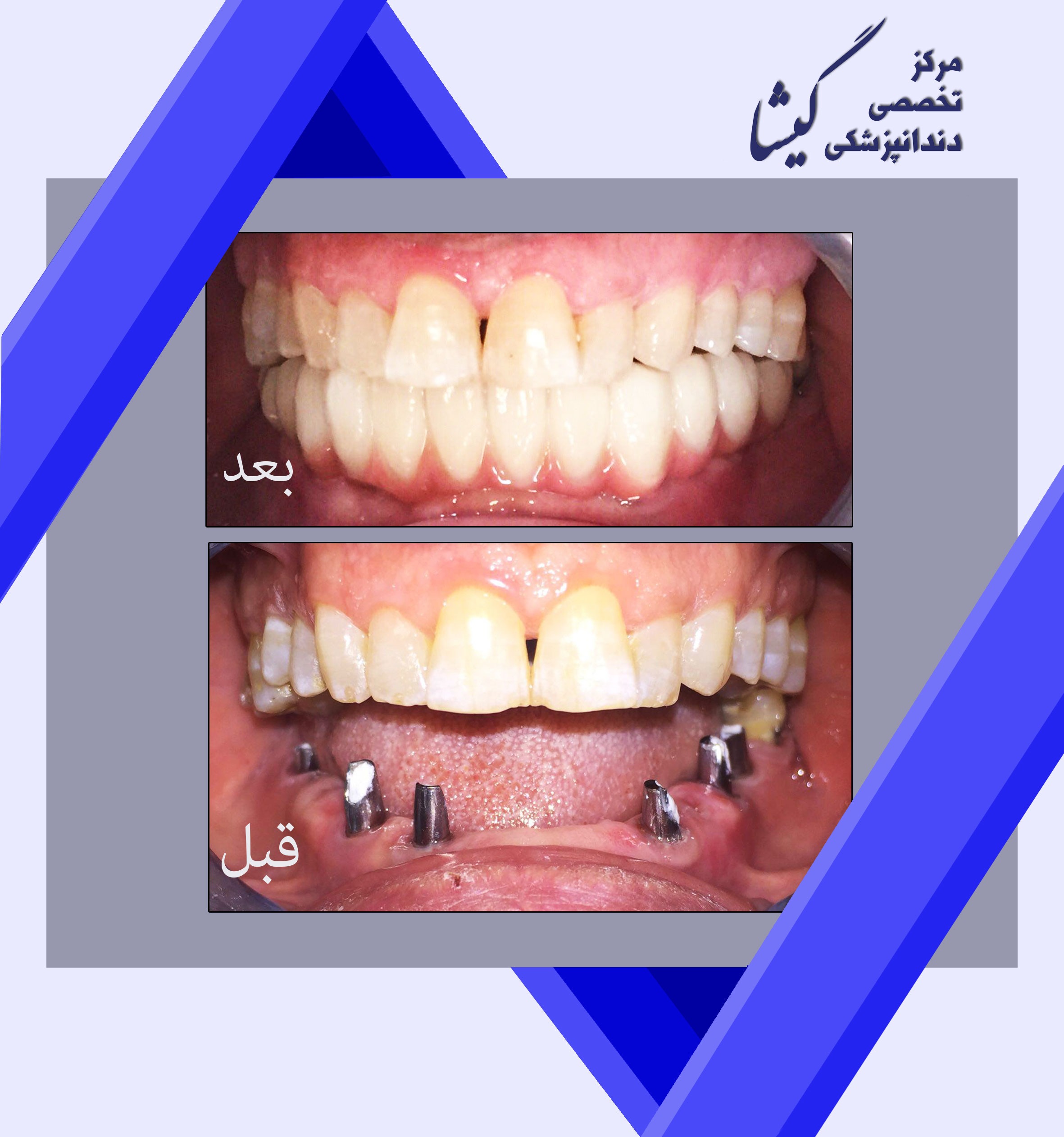 باز سازي دندانهاي فك پايين با ٦ پايه ايمپلنت و ١٣ واحد روكش