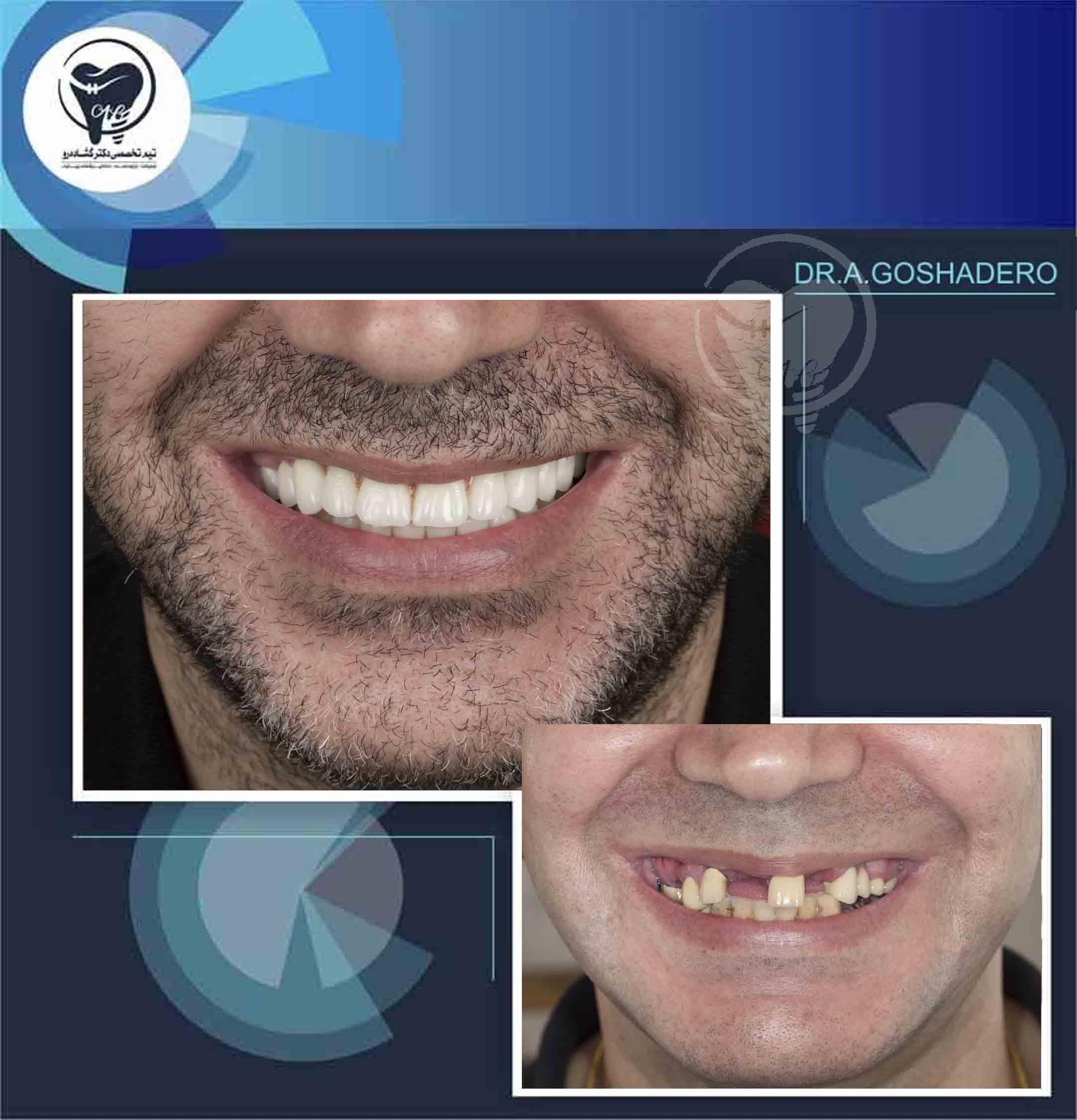 نمونه کار ایمپلنت دندان