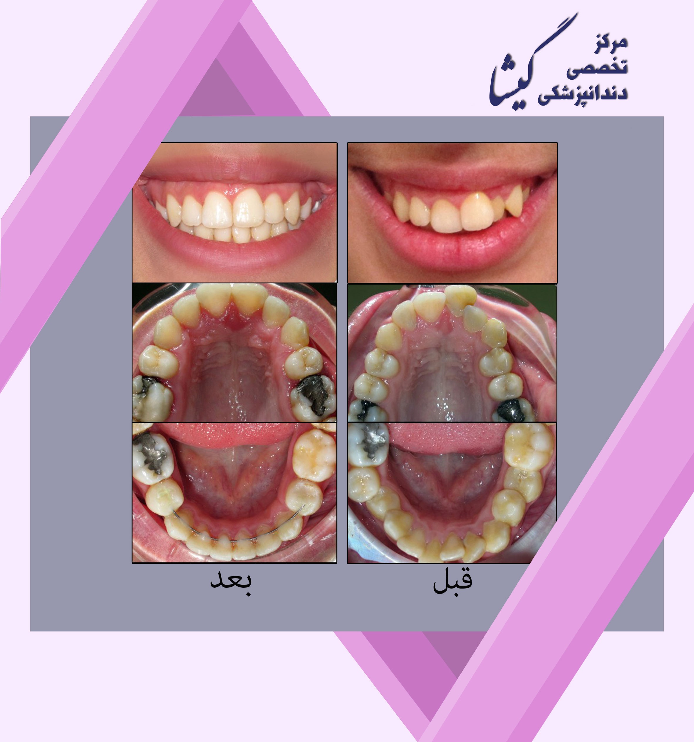 نامرتبي شديد دندانها