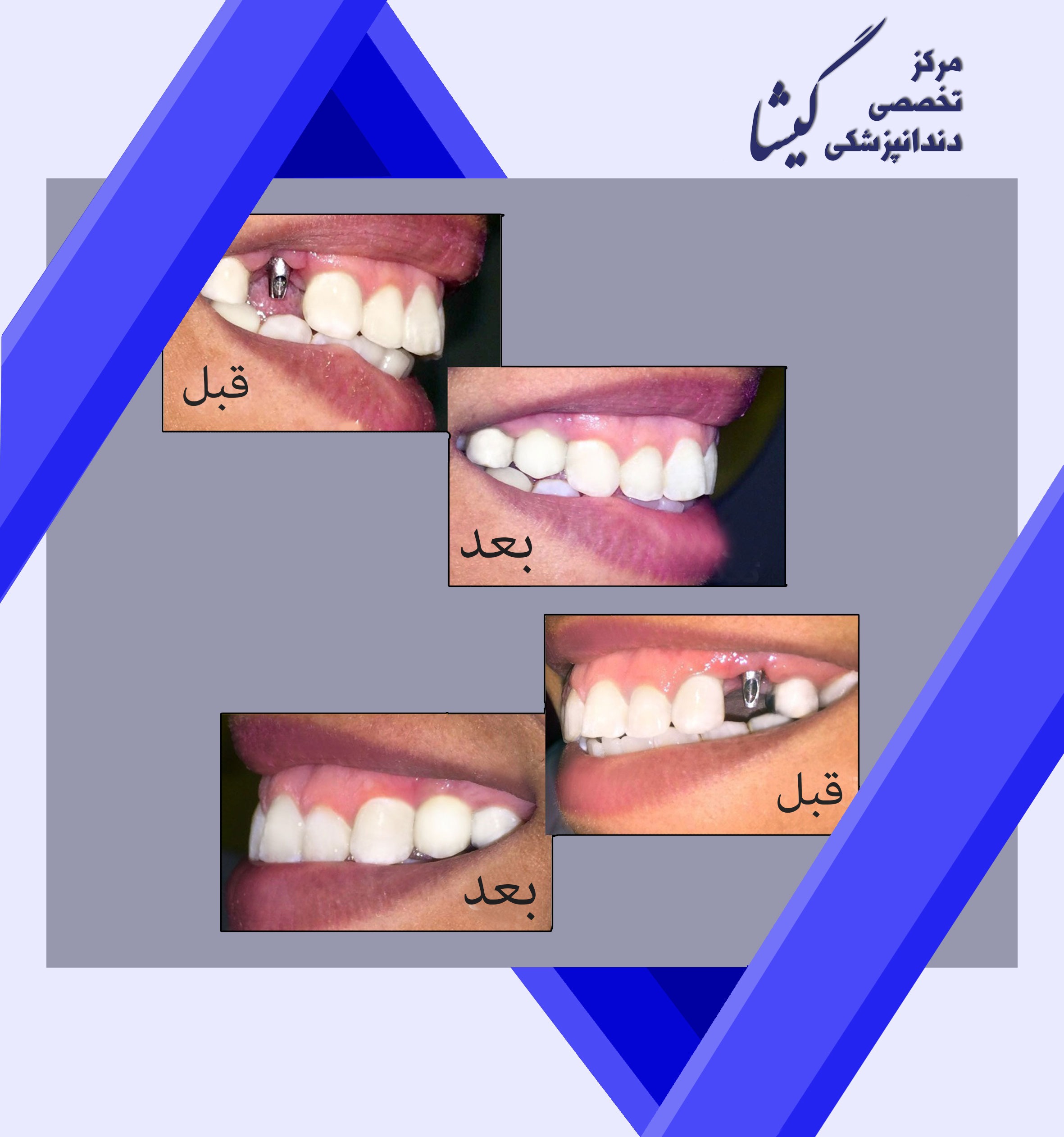 دو واحد ايمپلنت