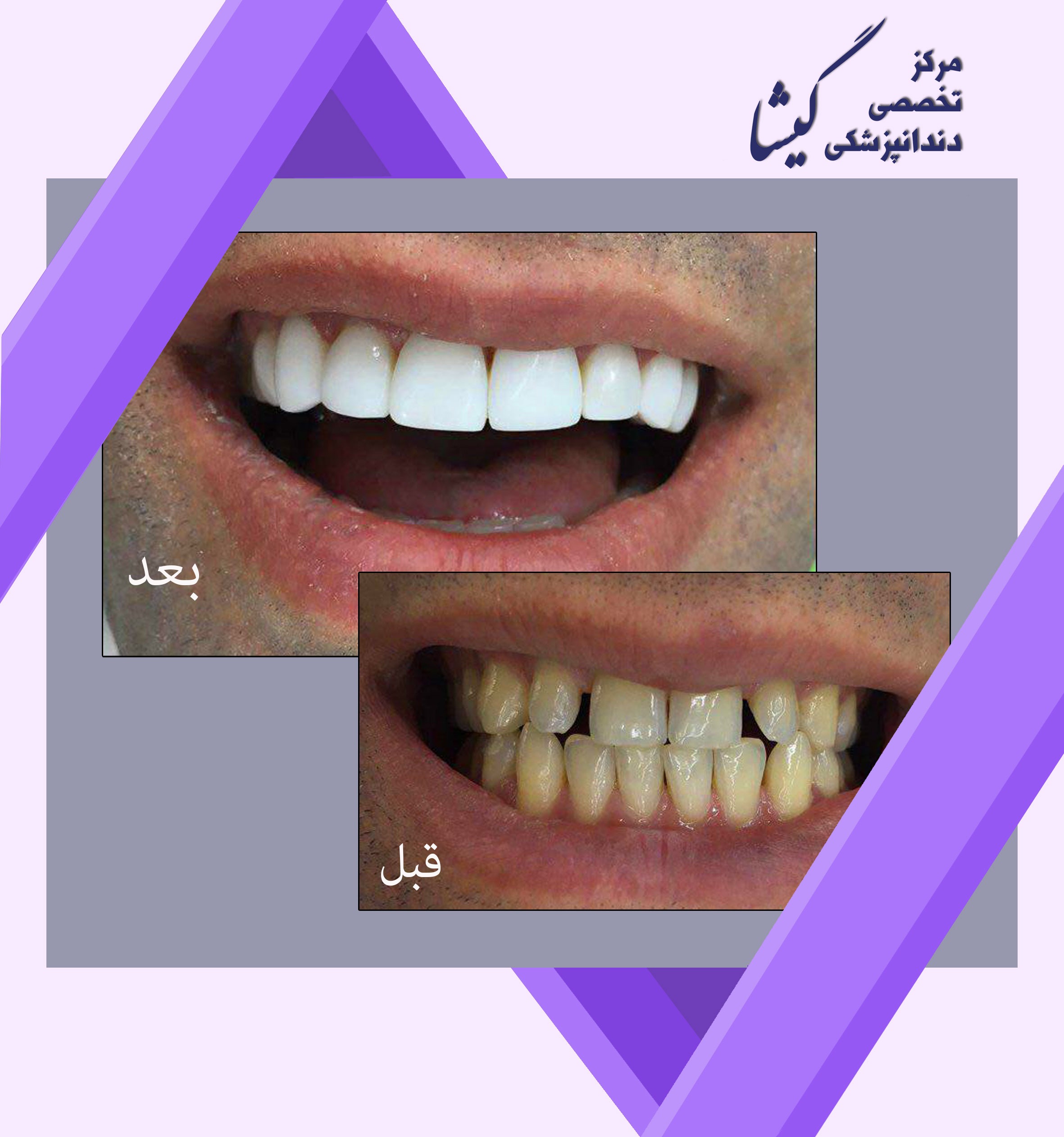 ونير كامپوزيت