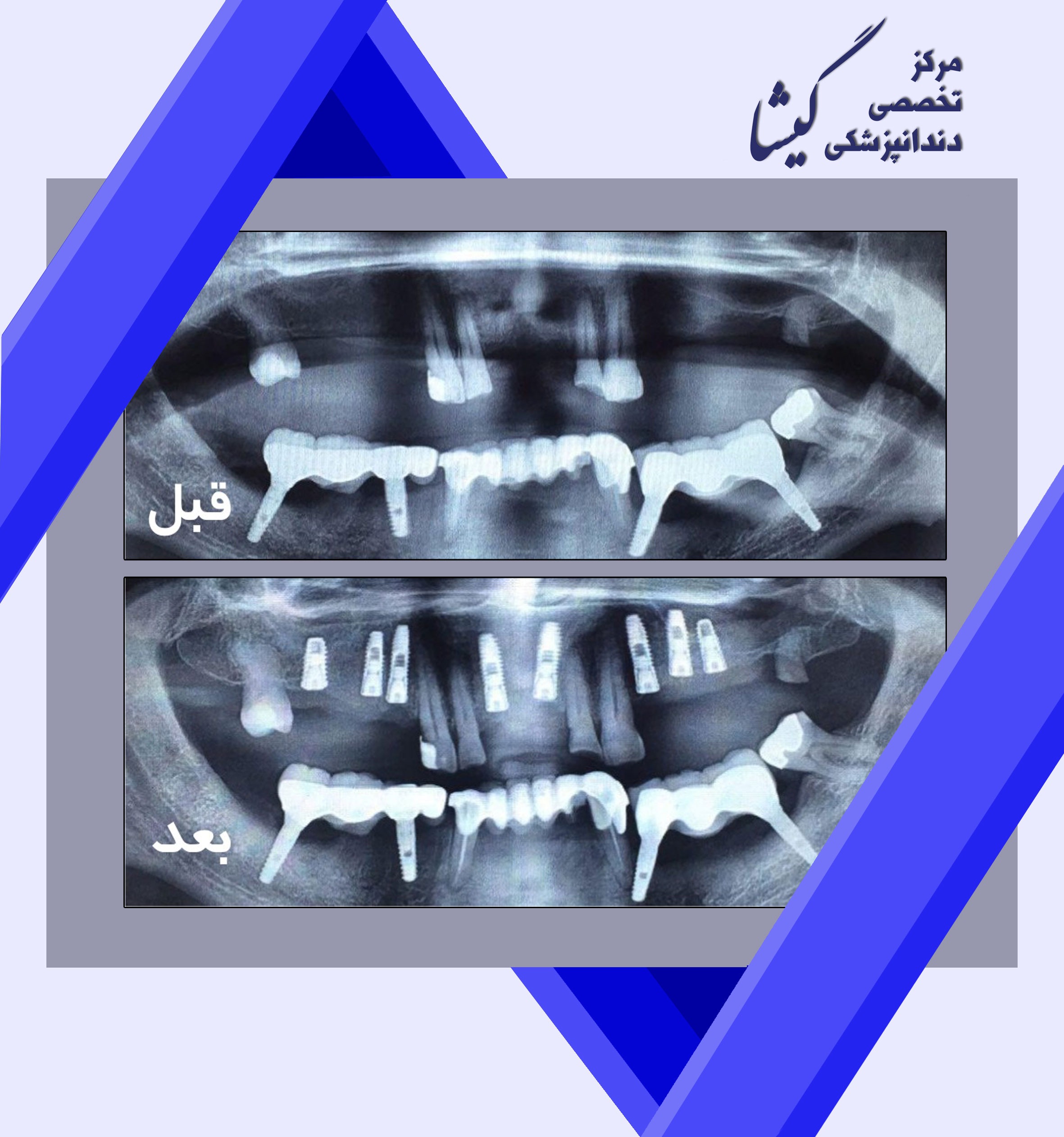پیوند سینوس