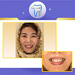 درمان ایمپلنت دندانها توسط متخصص ایمپلنت و پروتز در تهران( دکتر عزیز گشاده رو ، متخصص ایمپلنت و پروتز دندان ، استاد دانشگاه شهید بهشتی، رتبه اول بورد کشور)