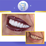 روکش تمام سرامیک دندانهای بالا  توسط متخصص پروتزهای دندانی و ایمپلنت( دکتر عزیز گشاده رو ، هیئت علمی دانشگاه شهید بهشتی ، رتبه اول بورد کشور)