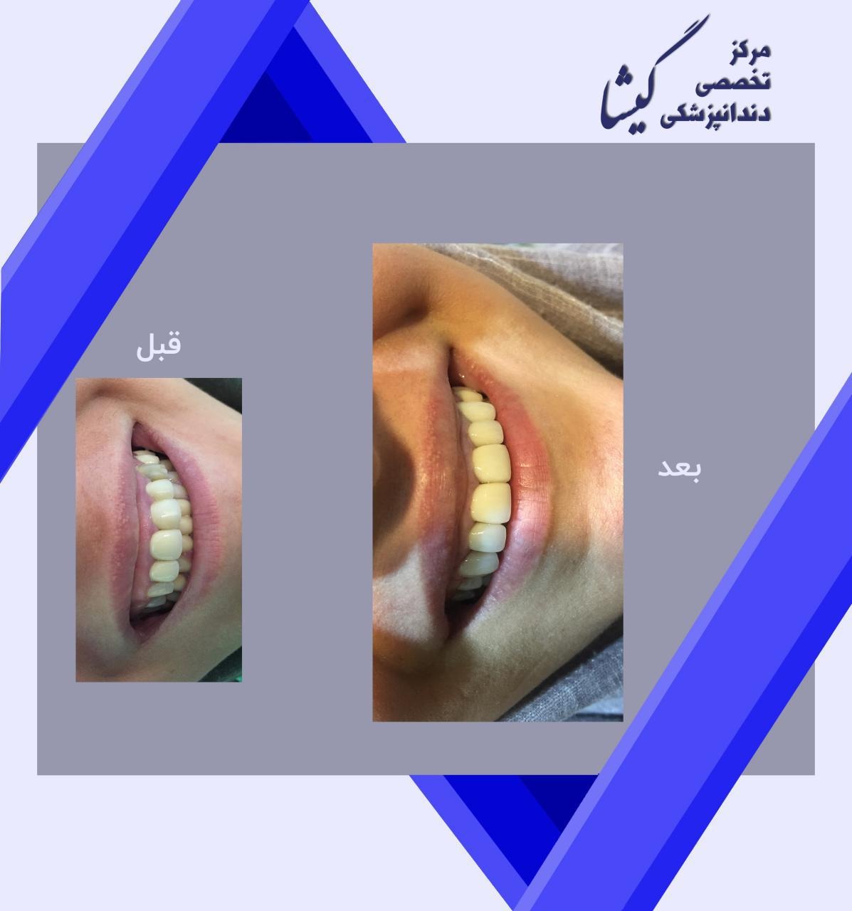 طراحی لبخند با تعویض روکشهای قدیمی فلزی