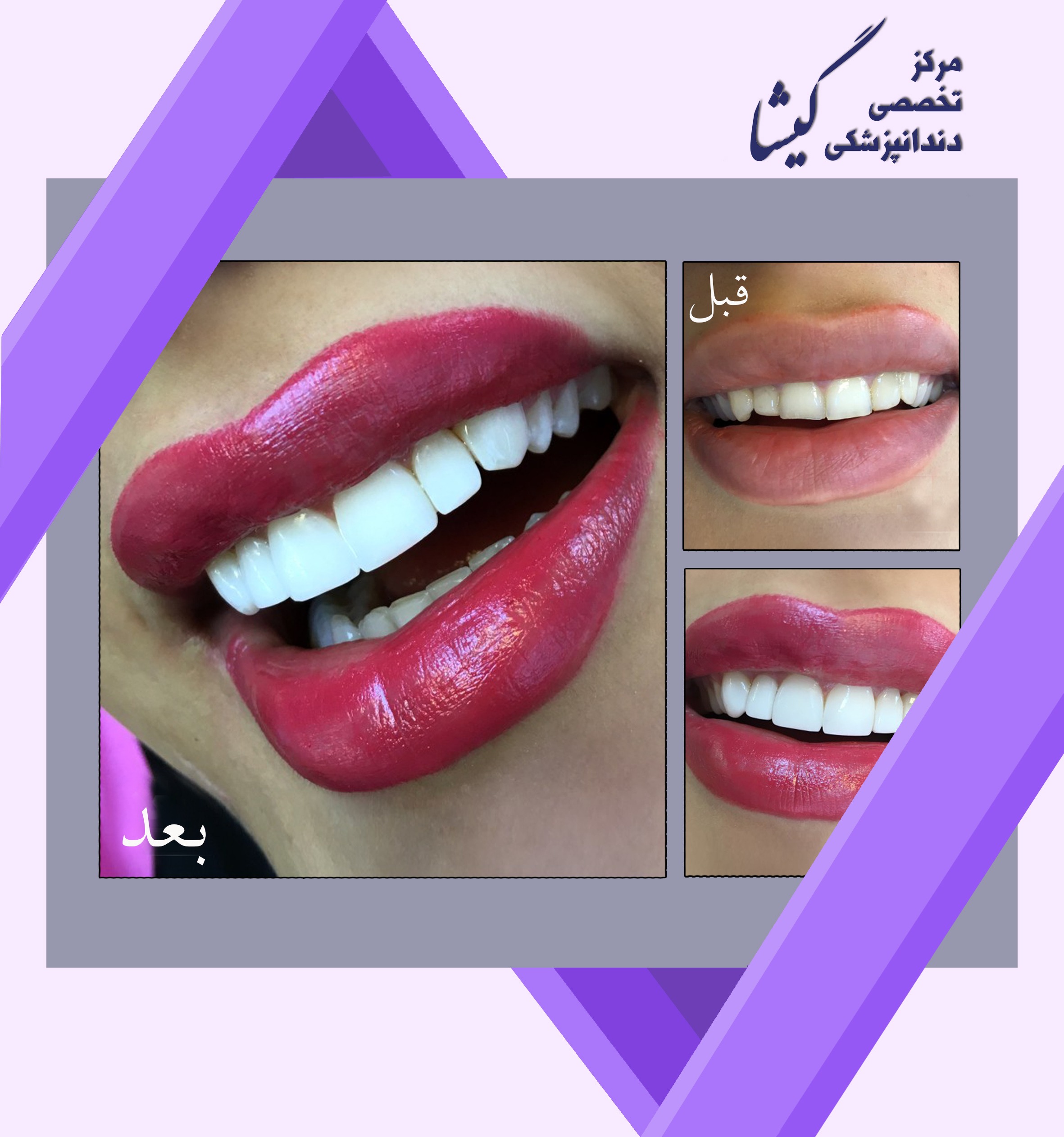 ونير كامپوزيت