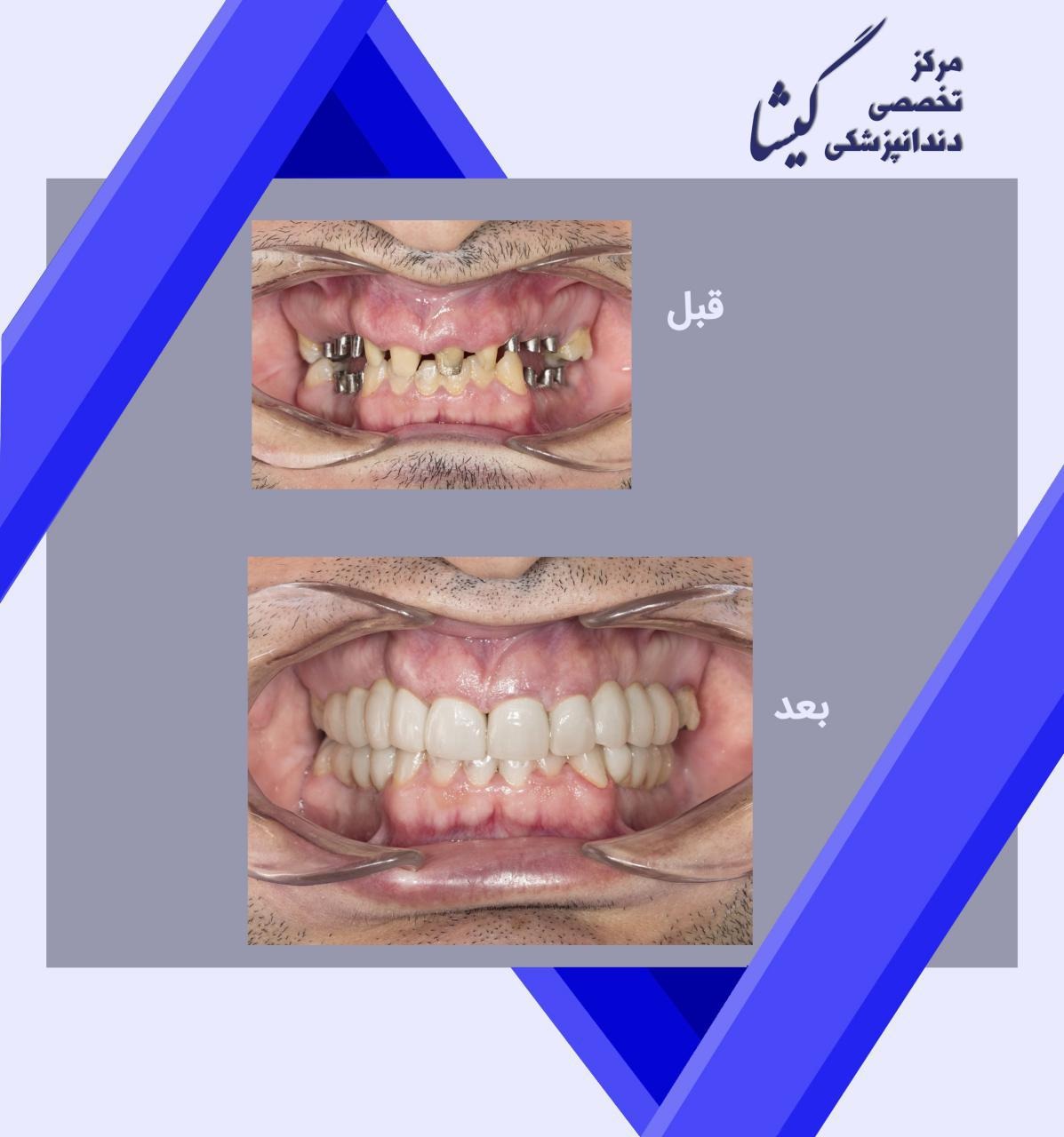 بازسازی دندانهای بیمار عزیزمان با ایمپلنت دندان و روکش