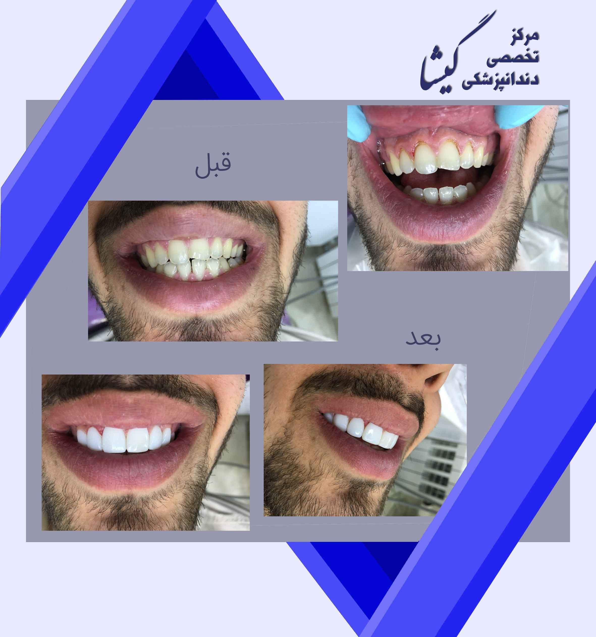 کامپوزیت ونیر
