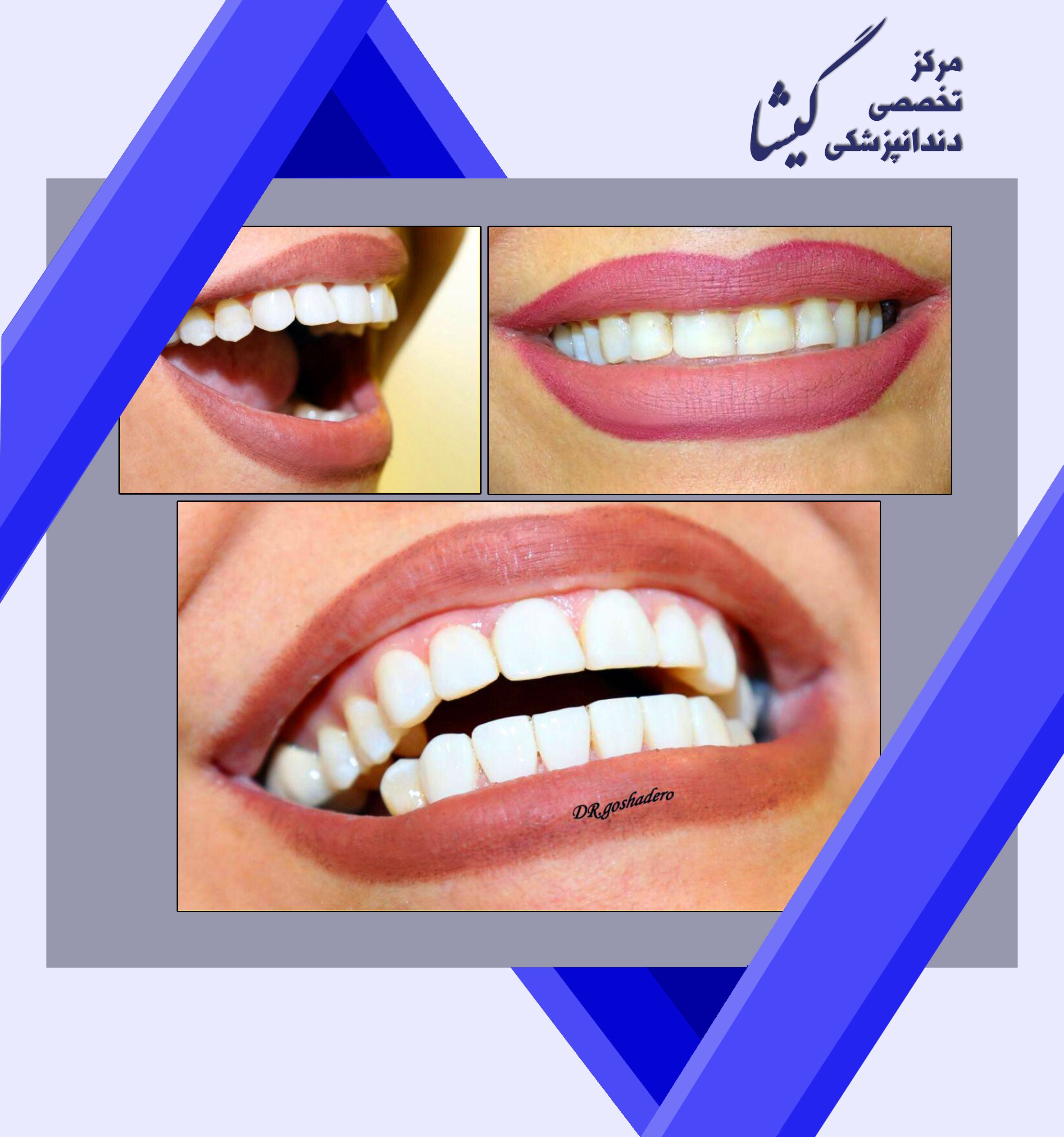 ونير كامپوزيت -  طراحي لبخند شما ، بدون نياز به تراش دندان
