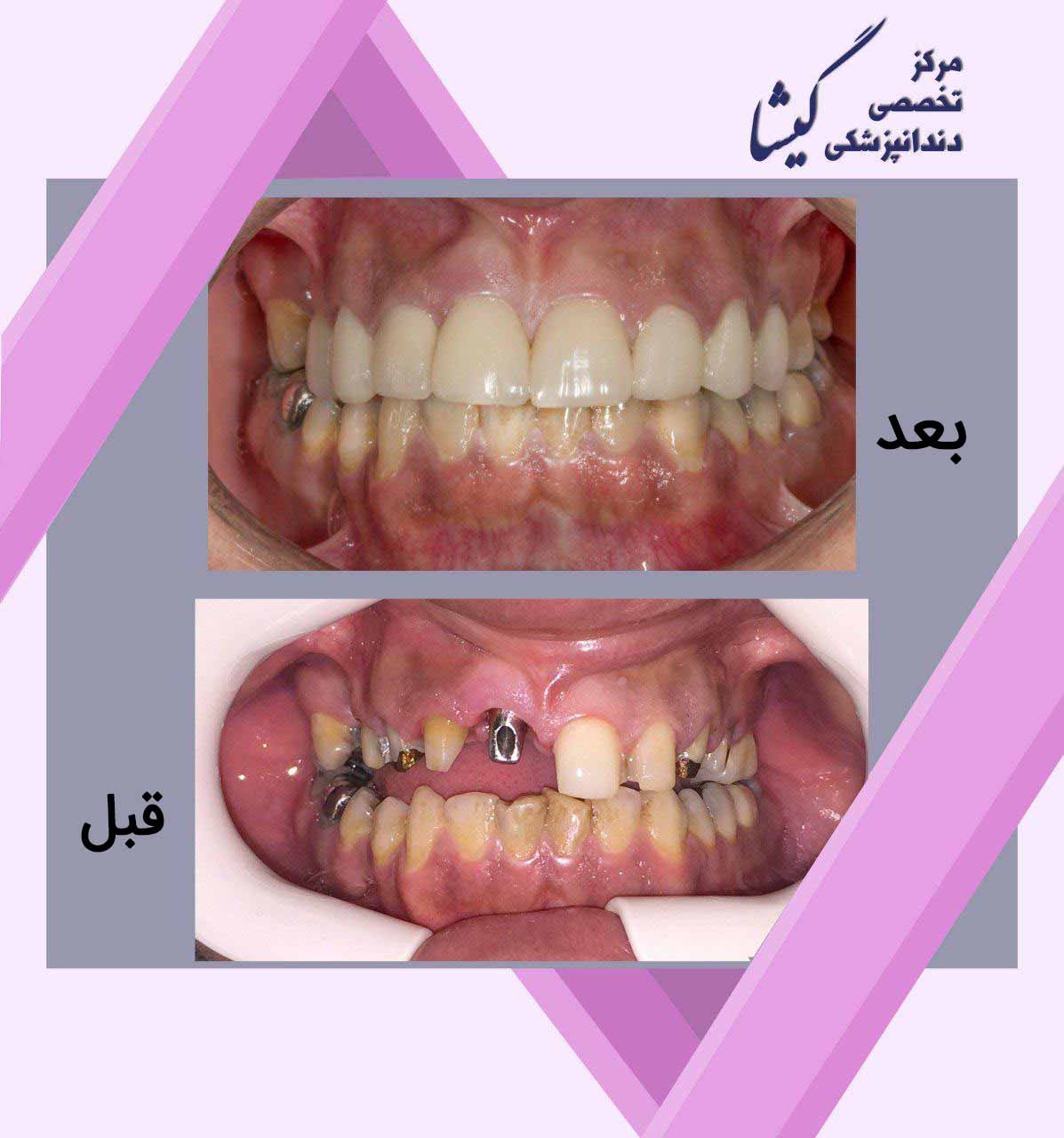 ۸ واحد روکش تمام سرامیک زیرکونیا.
