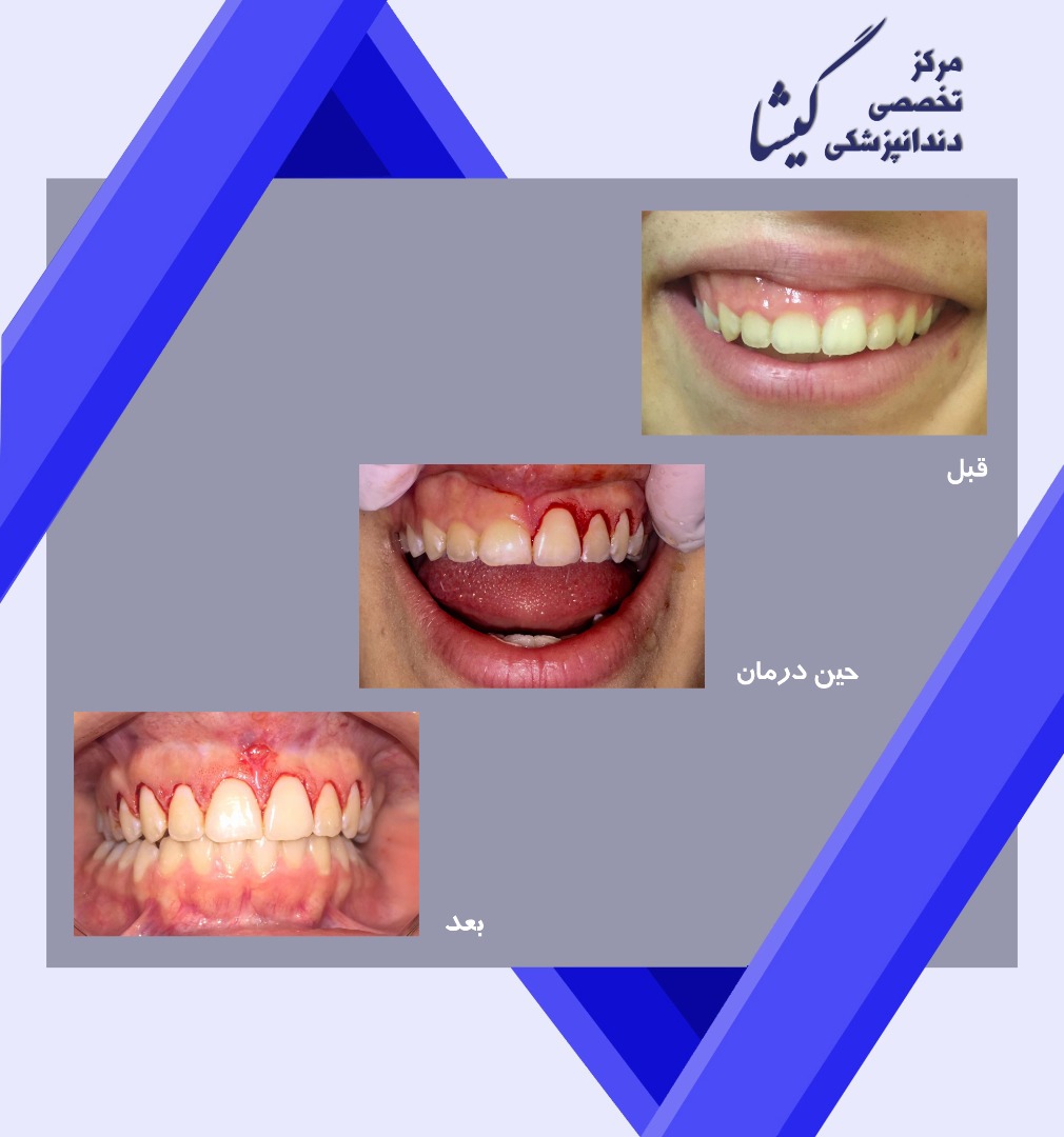 جراحی افزایش طول تاج( لیفت لثه)