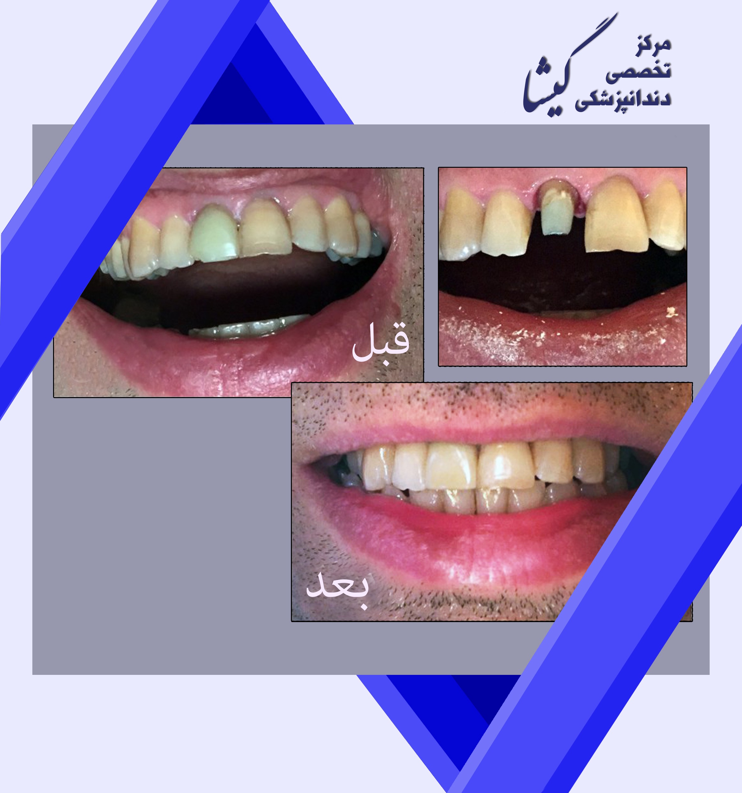 تحویل روکش تمام سرامیک به بیمار