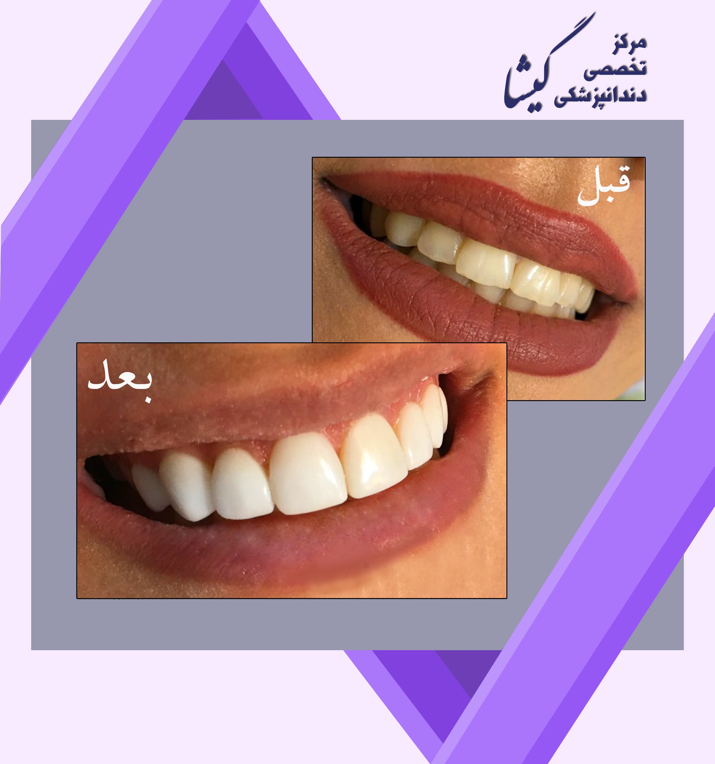 ونير كامپوزيت