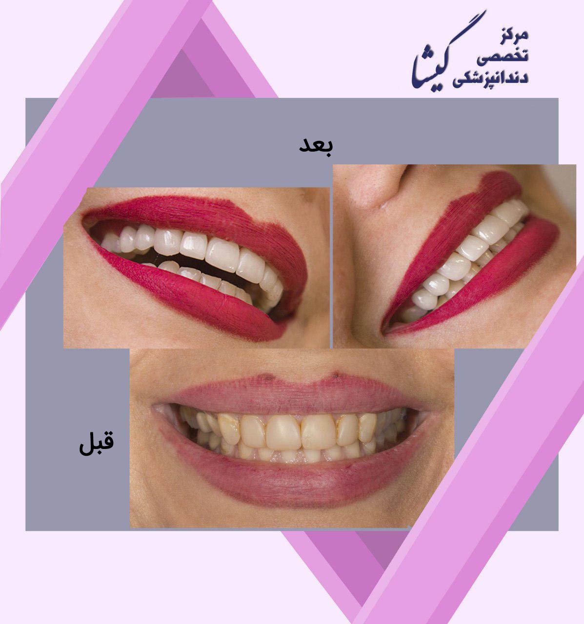 تعویض کامپوزیت های رنگ گرفته دندانهای بالا با لامینیت های سرامیکی