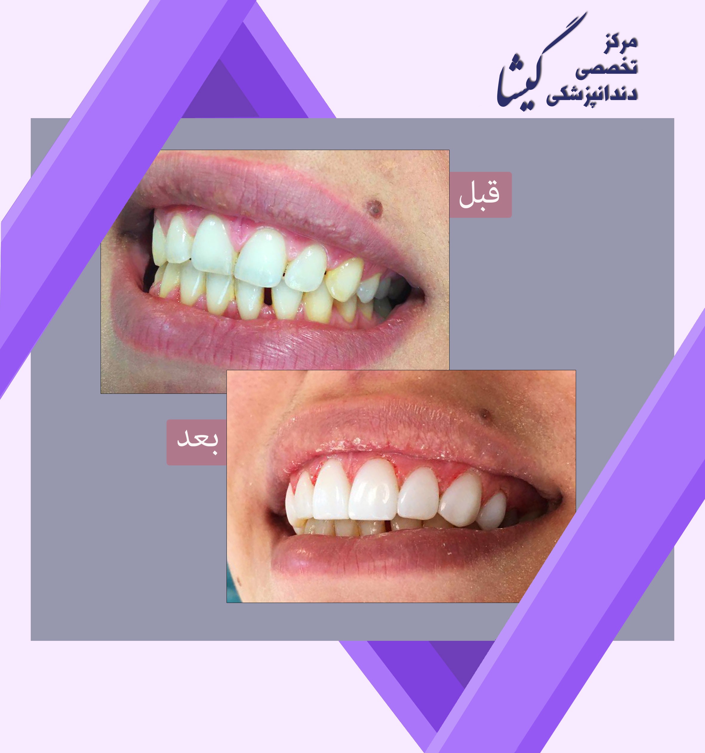 کامپوزیت ونیر