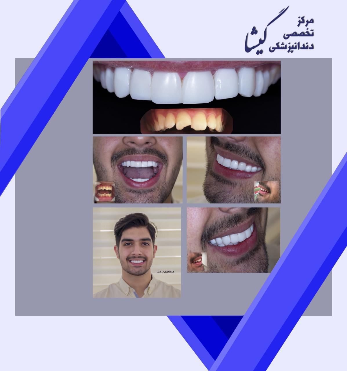 طراحی لبخند با ۱۰ واحد کامپوزیت ونیر