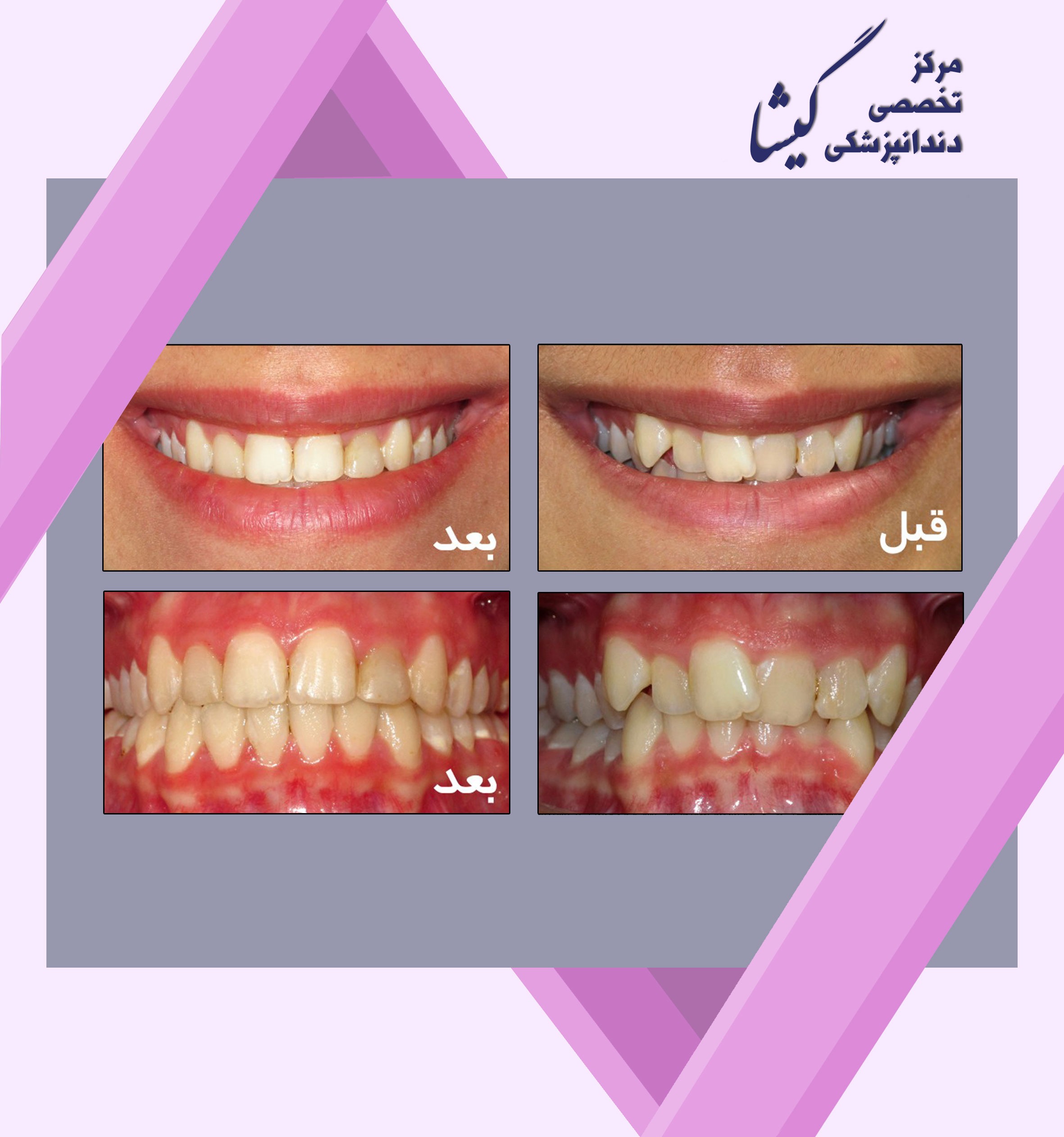 اجتناب از کشیدن دندان و استفاده از متدهای دیگر