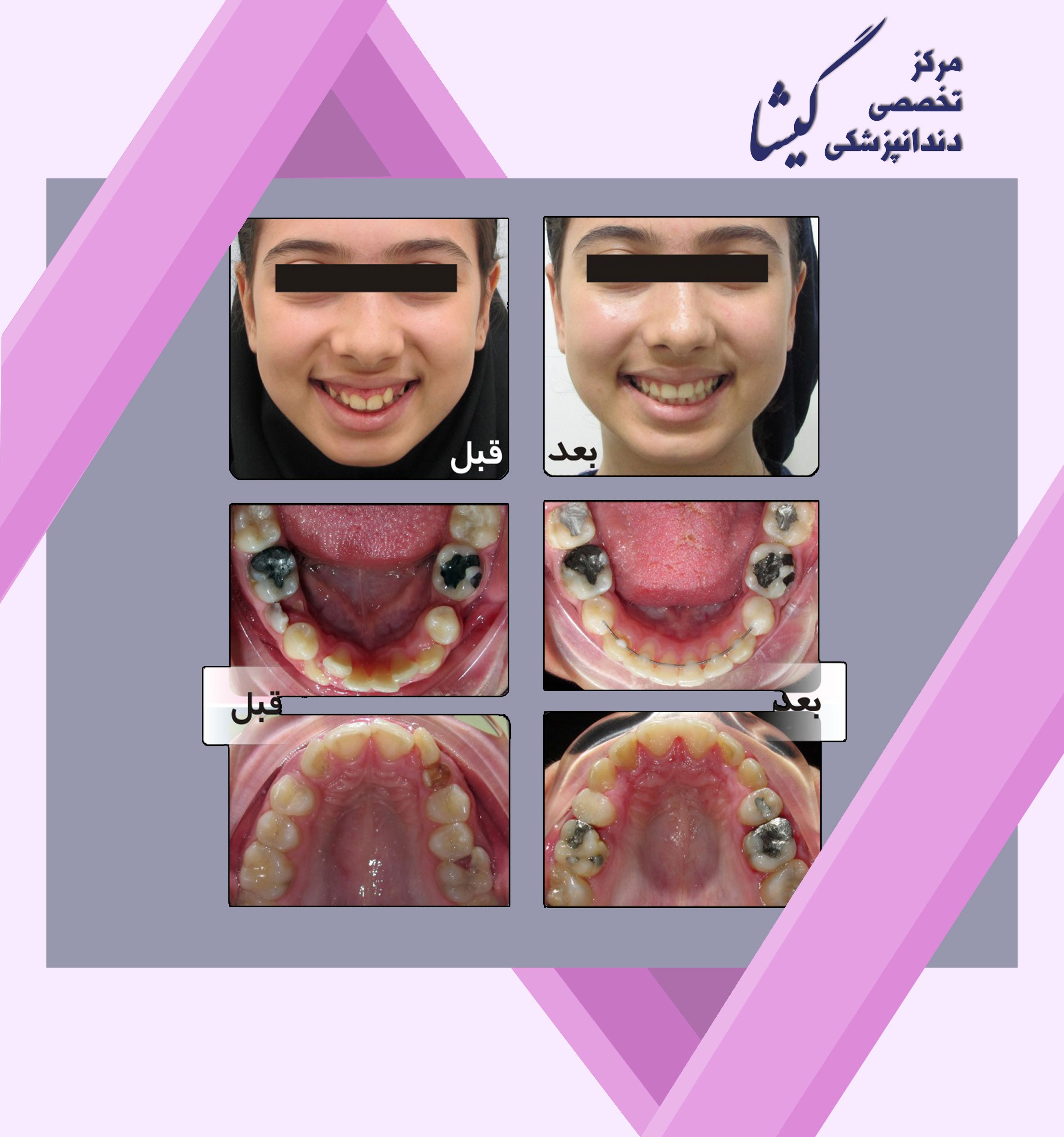 یک بیمار درمان شده در سن 12 سالگی به علت نهفته بودن  دو دندان نیش فک بالا، 2 دندان آسیای کوچک از بیمار کشیده شد.